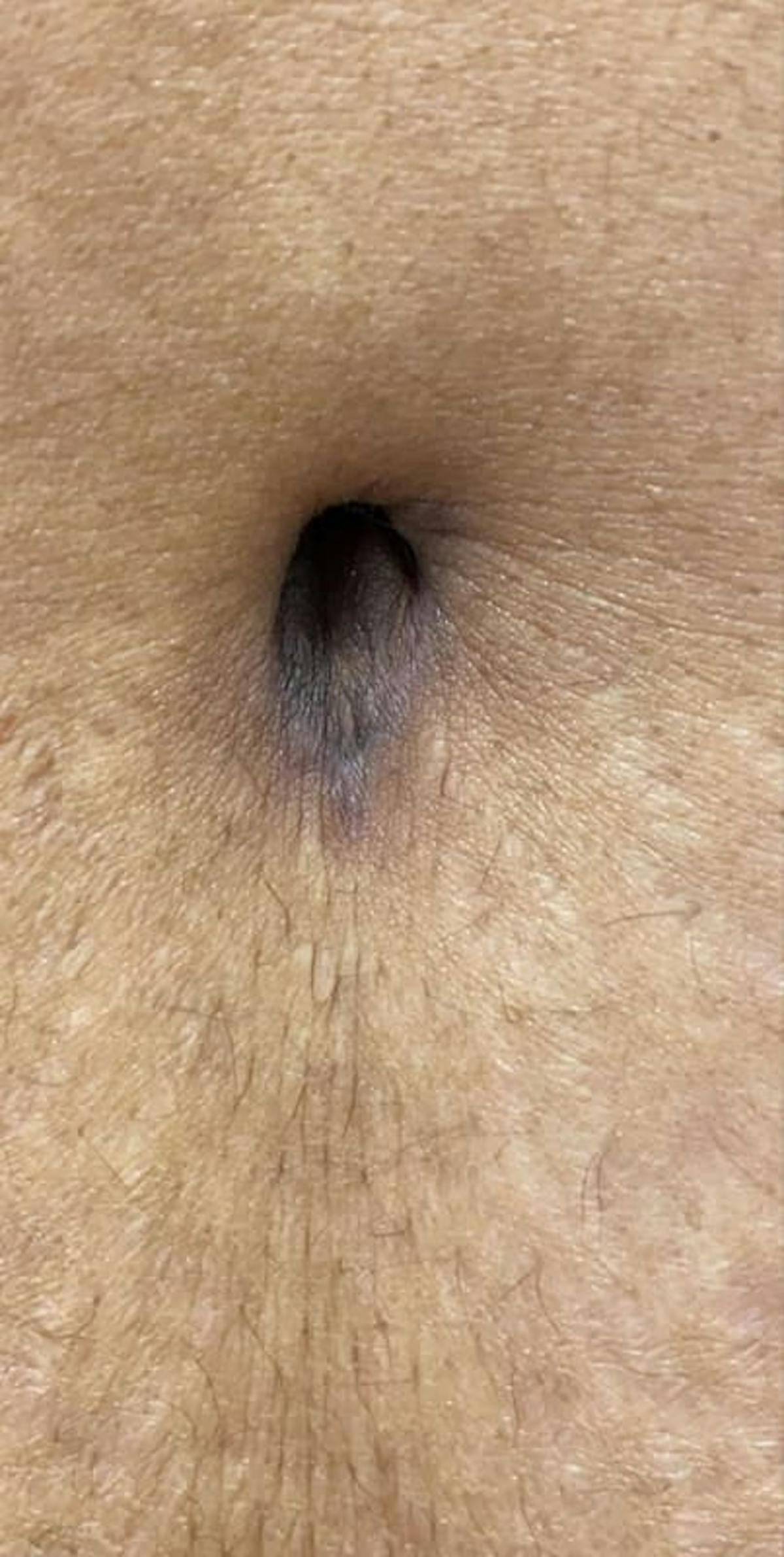 Belly Button Before & After Gallery - Patient 313602 - Image 1