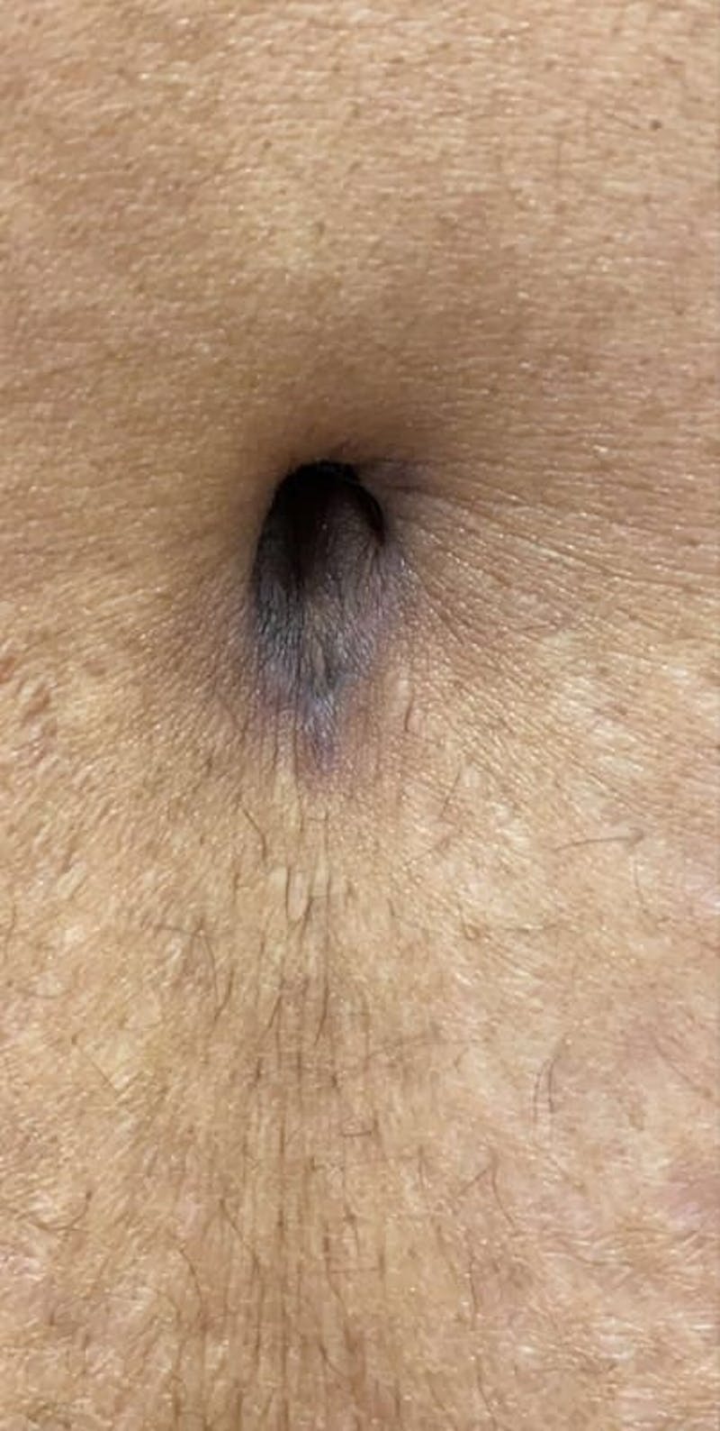 Belly Button Before & After Gallery - Patient 313602 - Image 1