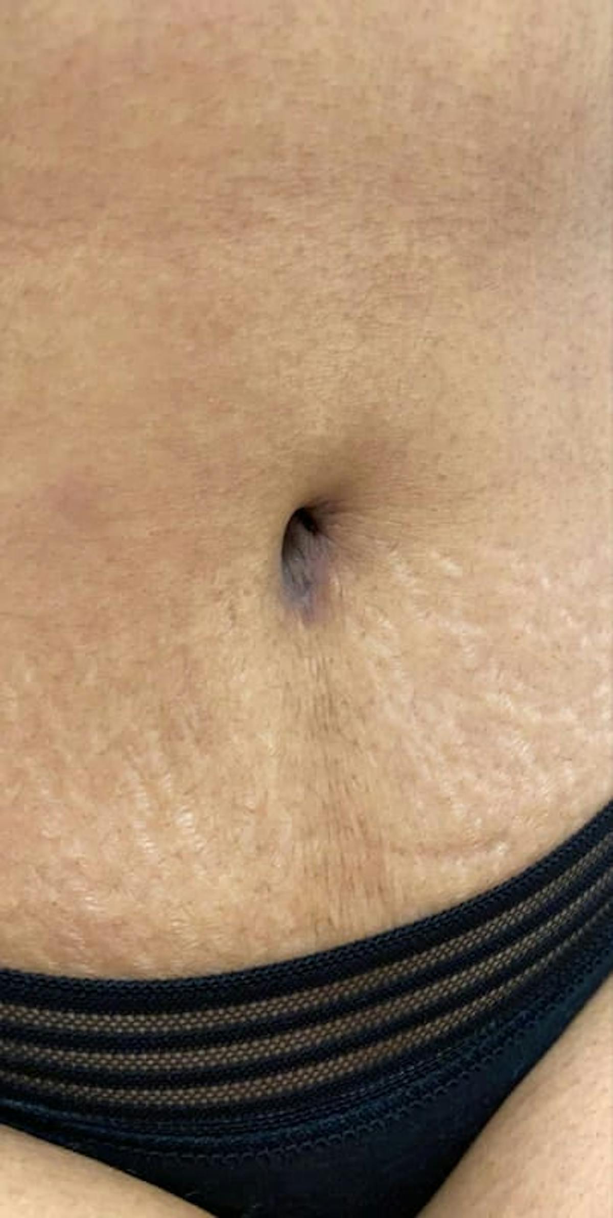 Belly Button Before & After Gallery - Patient 313602 - Image 2