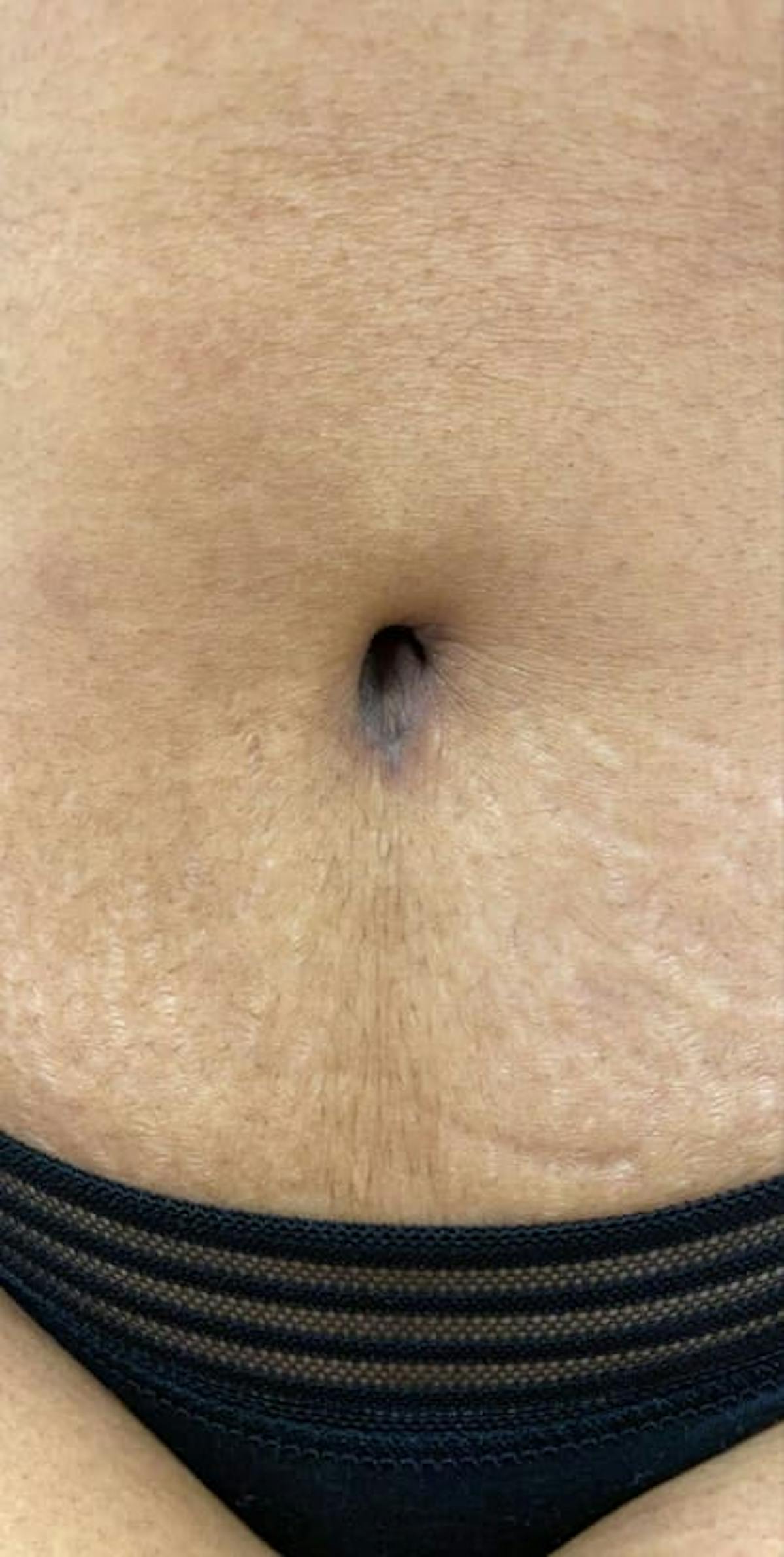 Belly Button Before & After Gallery - Patient 313602 - Image 3
