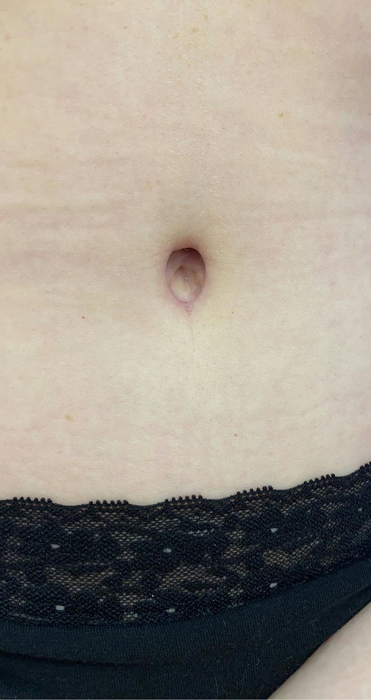 Belly Button Before & After Gallery - Patient 151173 - Image 1