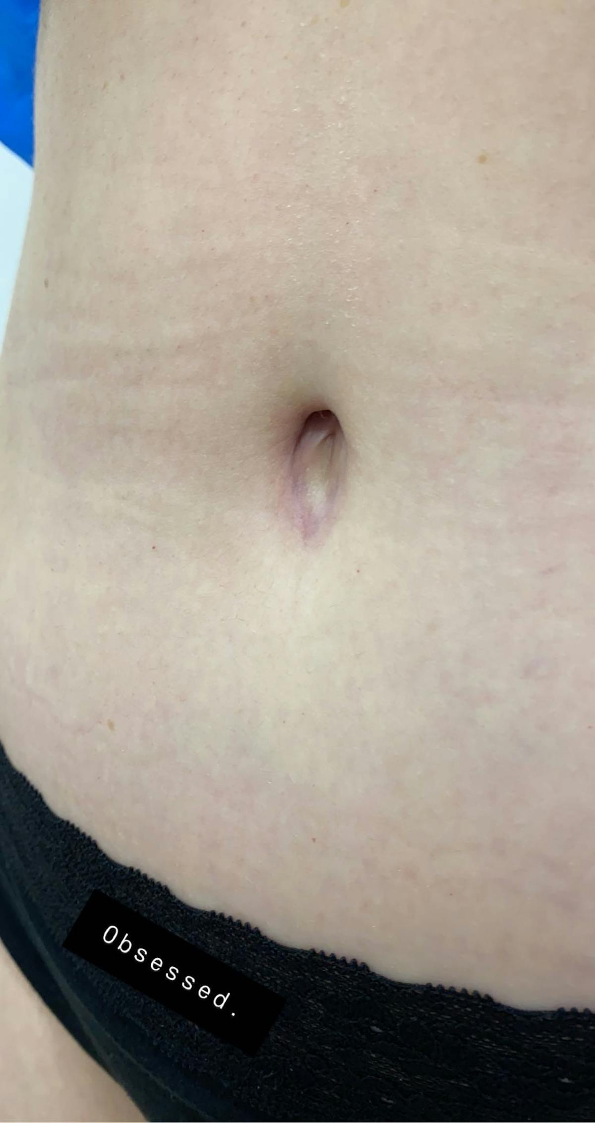 Belly Button Before & After Gallery - Patient 151173 - Image 2