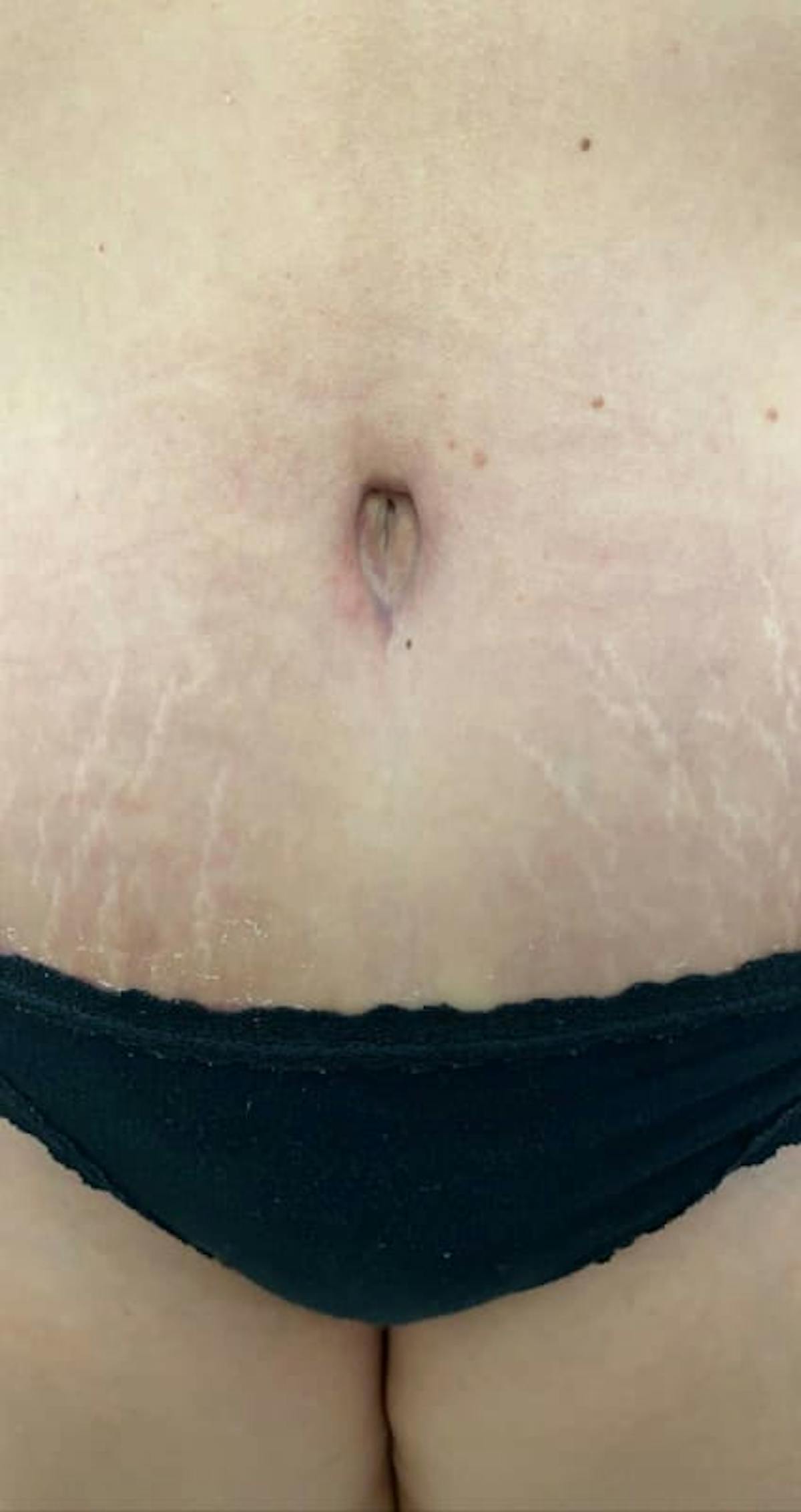 Belly Button Before & After Gallery - Patient 273599 - Image 1
