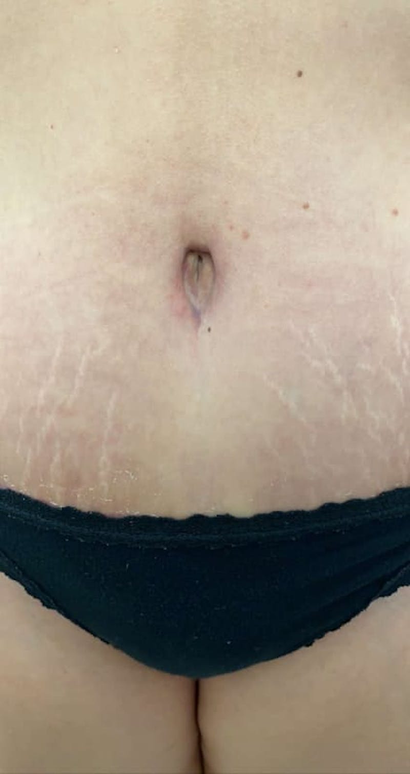 Belly Button Before & After Gallery - Patient 273599 - Image 1