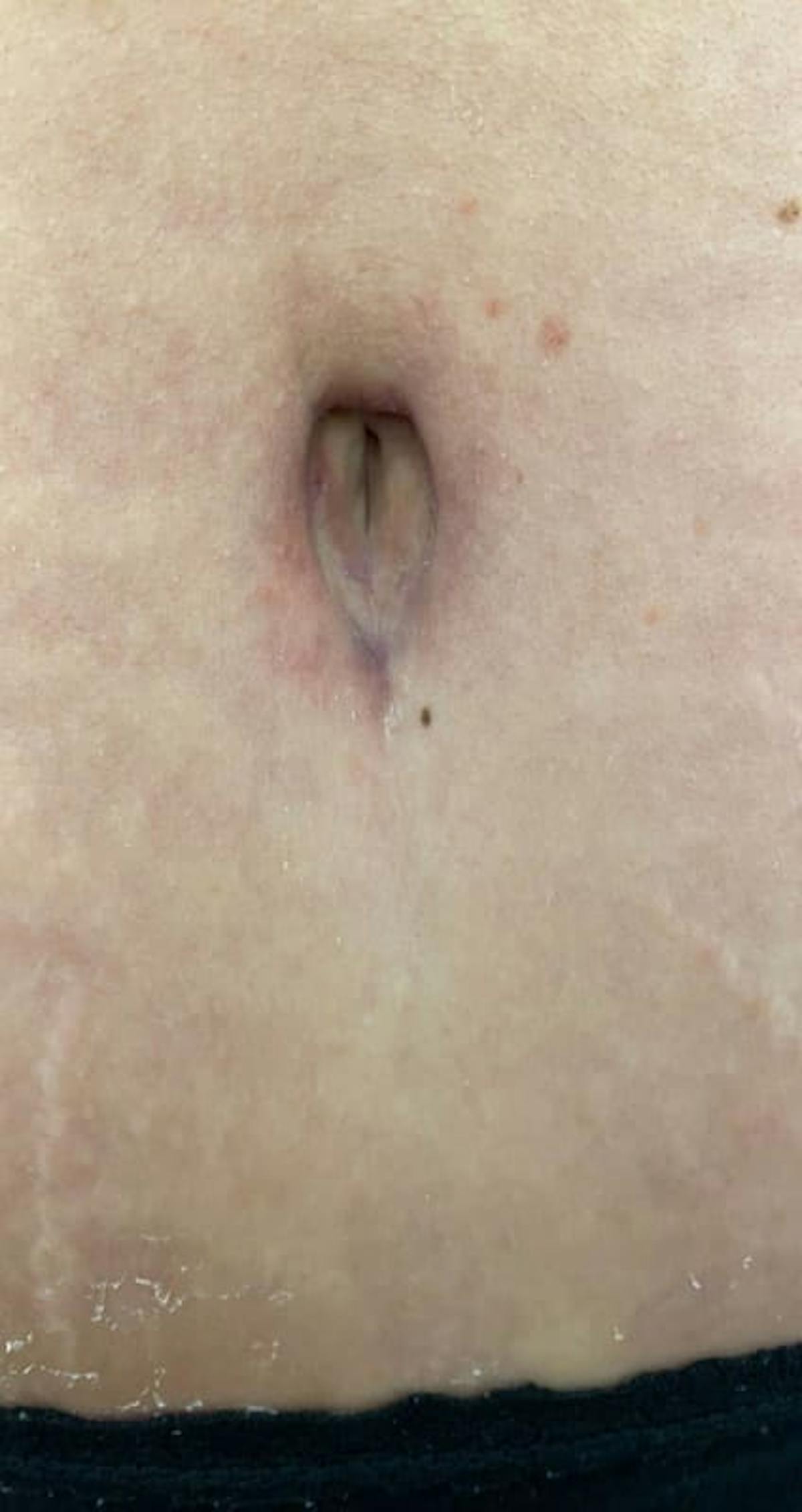 Belly Button Before & After Gallery - Patient 273599 - Image 2