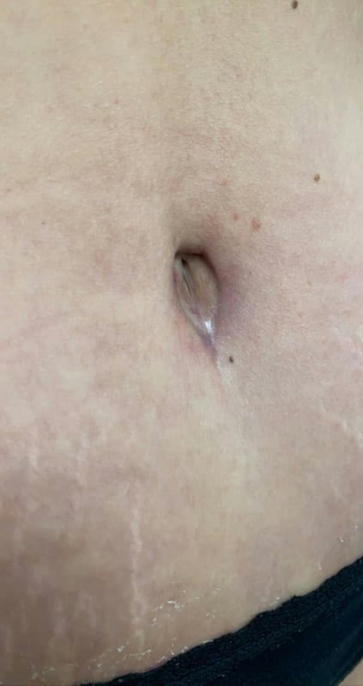 Belly Button Before & After Gallery - Patient 273599 - Image 3