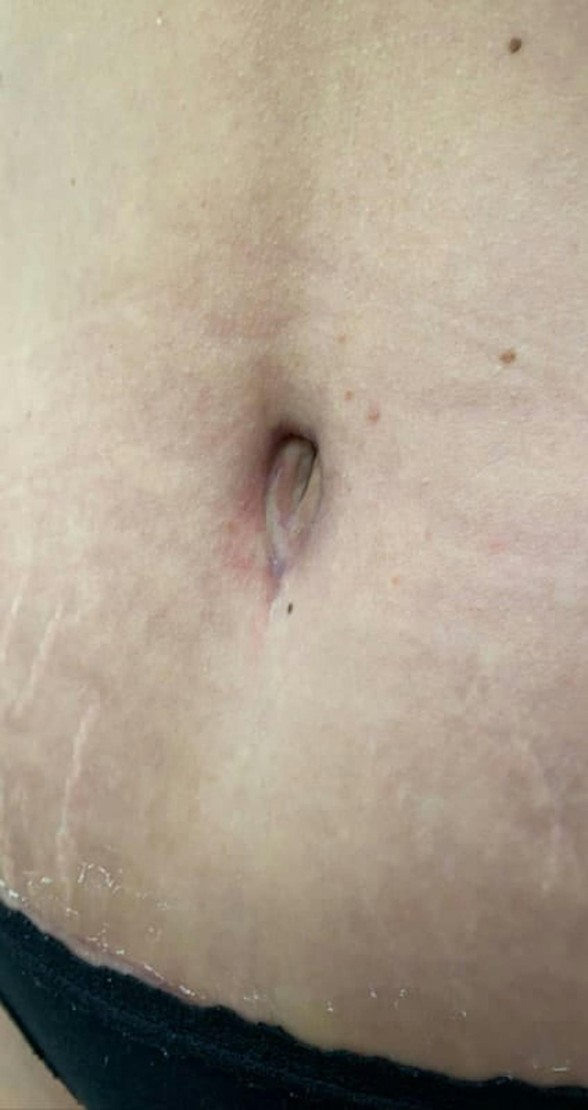 Belly Button Before & After Gallery - Patient 273599 - Image 4