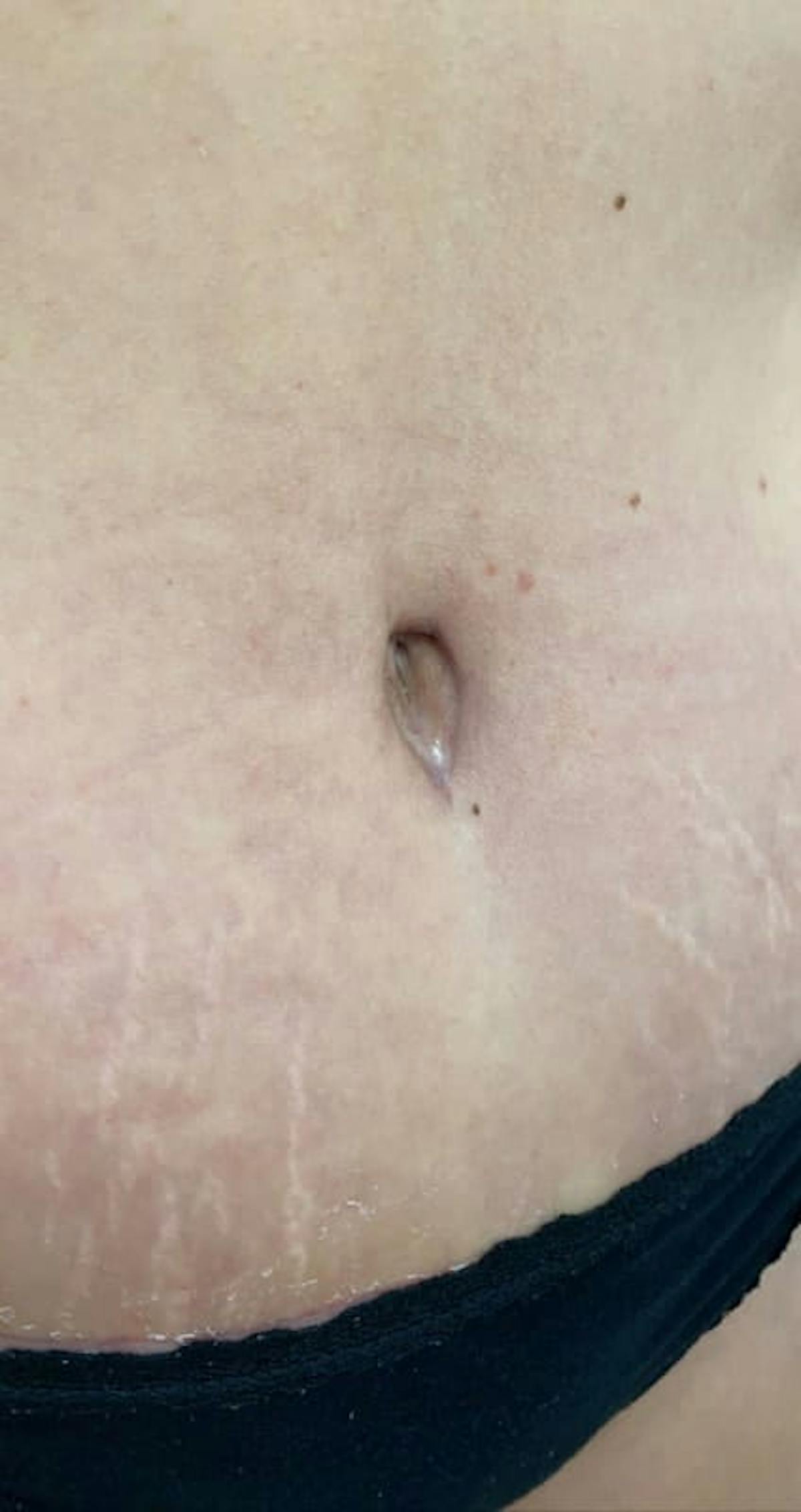 Belly Button Before & After Gallery - Patient 273599 - Image 5