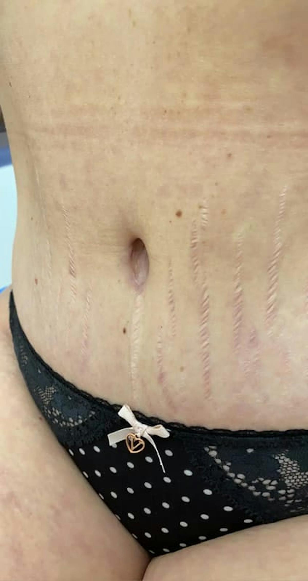 Belly Button Before & After Gallery - Patient 242738 - Image 1