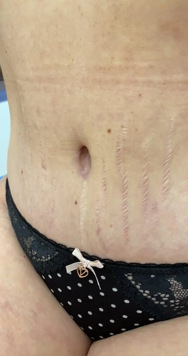 Belly Button Before & After Gallery - Patient 242738 - Image 1