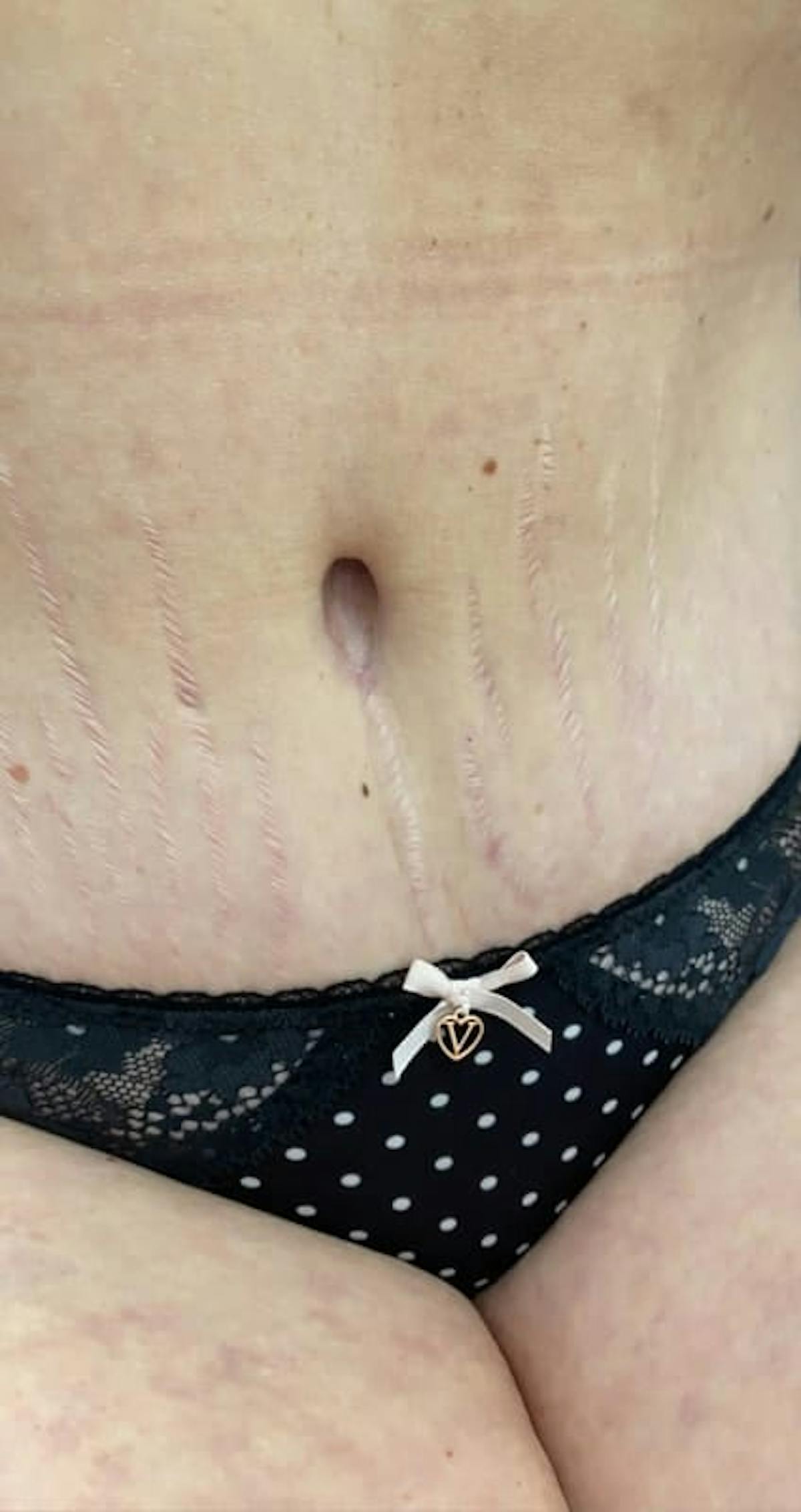 Belly Button Before & After Gallery - Patient 242738 - Image 2
