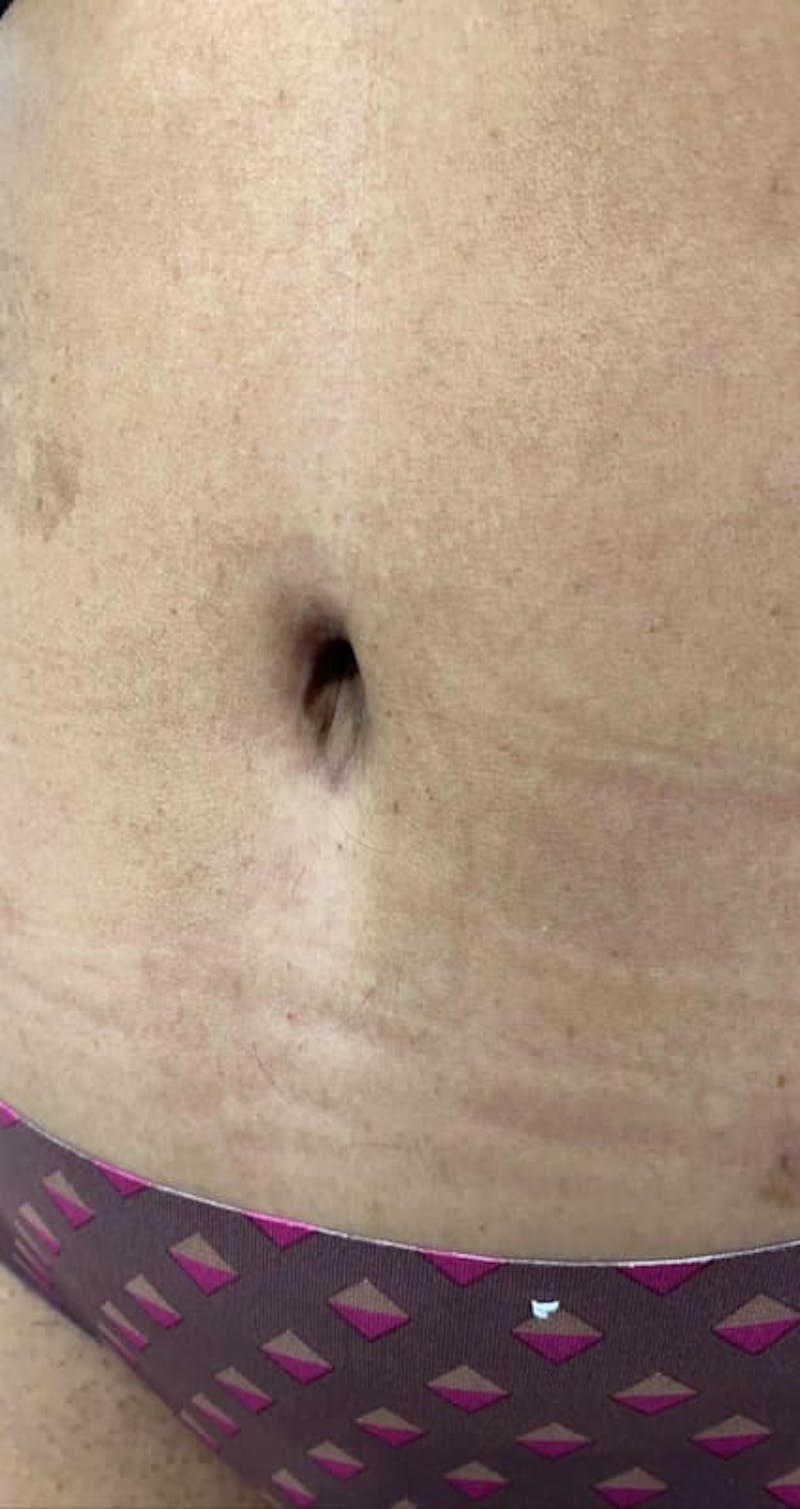 Belly Button Before & After Gallery - Patient 187211 - Image 1