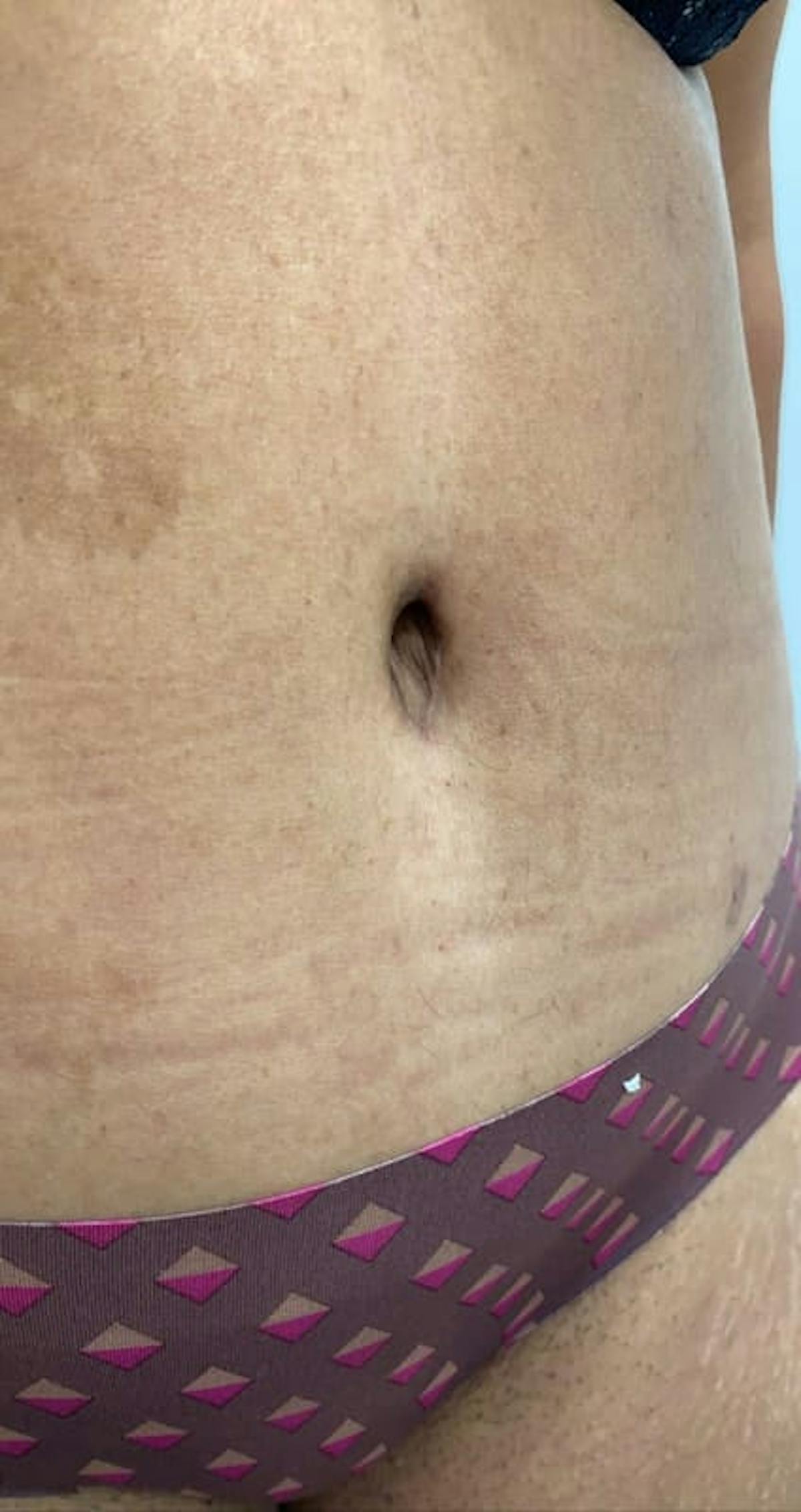 Belly Button Before & After Gallery - Patient 187211 - Image 2