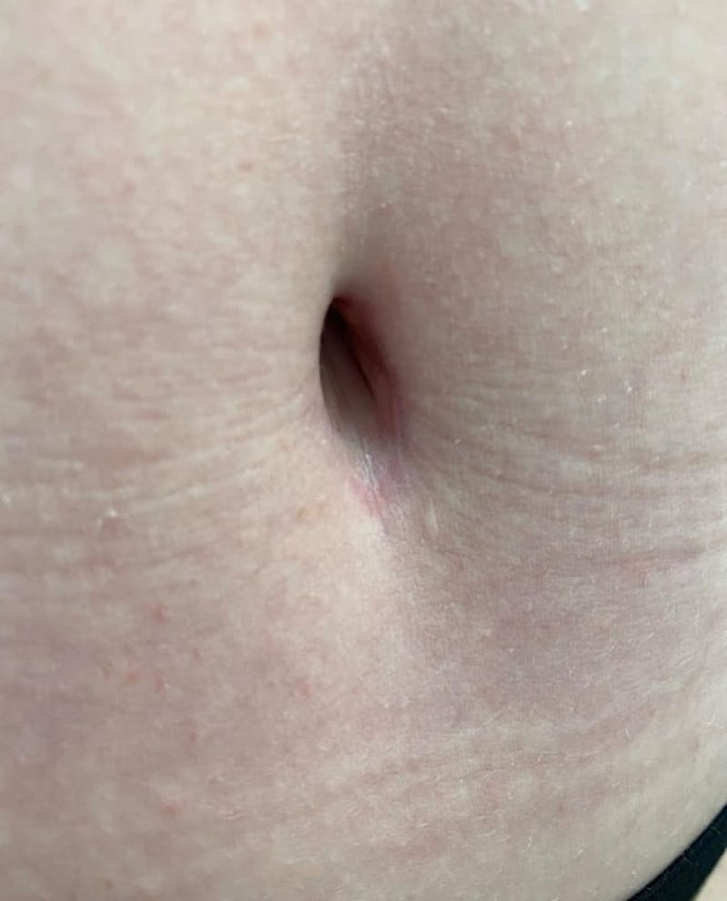 Belly Button Before & After Gallery - Patient 105929 - Image 1