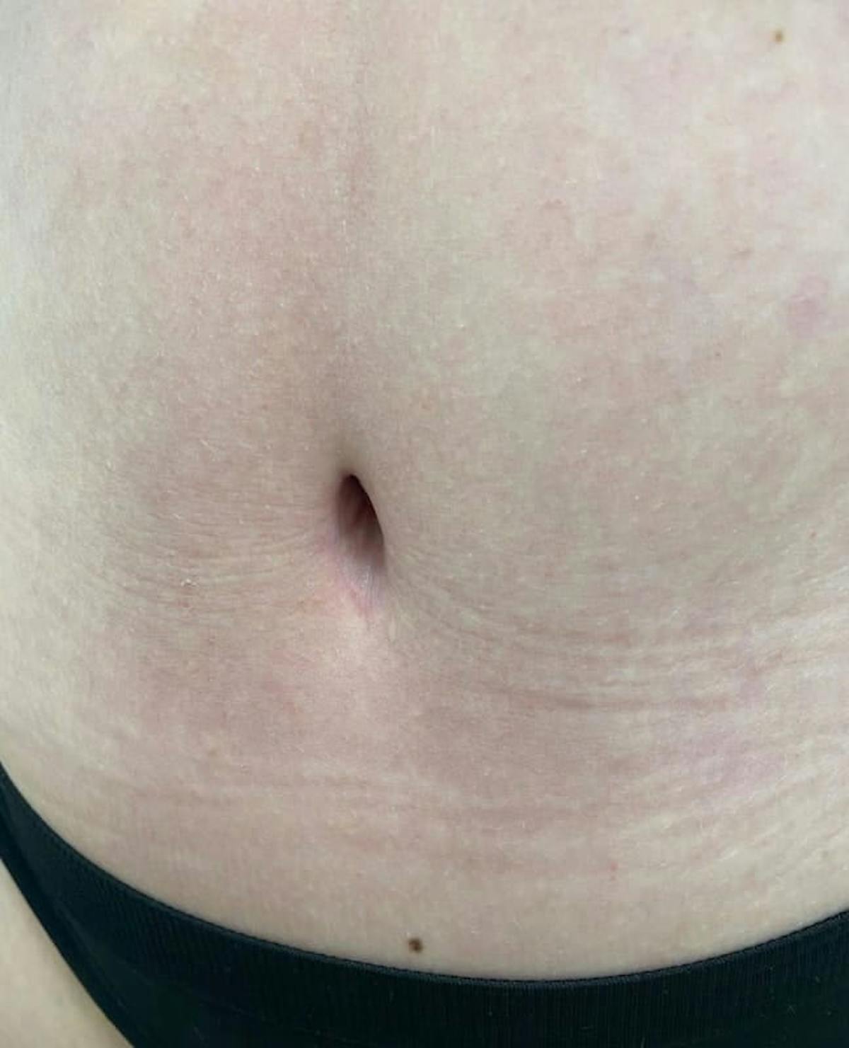 Belly Button Before & After Gallery - Patient 105929 - Image 2
