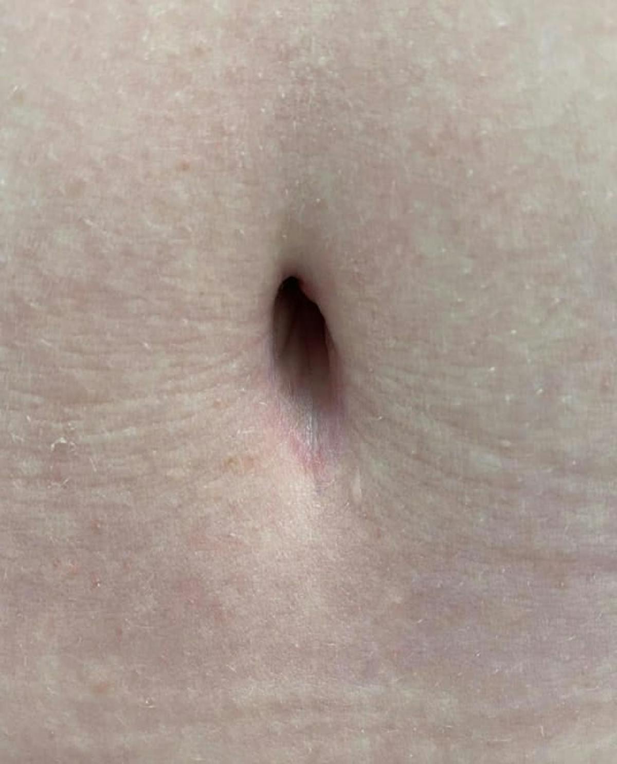 Belly Button Before & After Gallery - Patient 105929 - Image 3