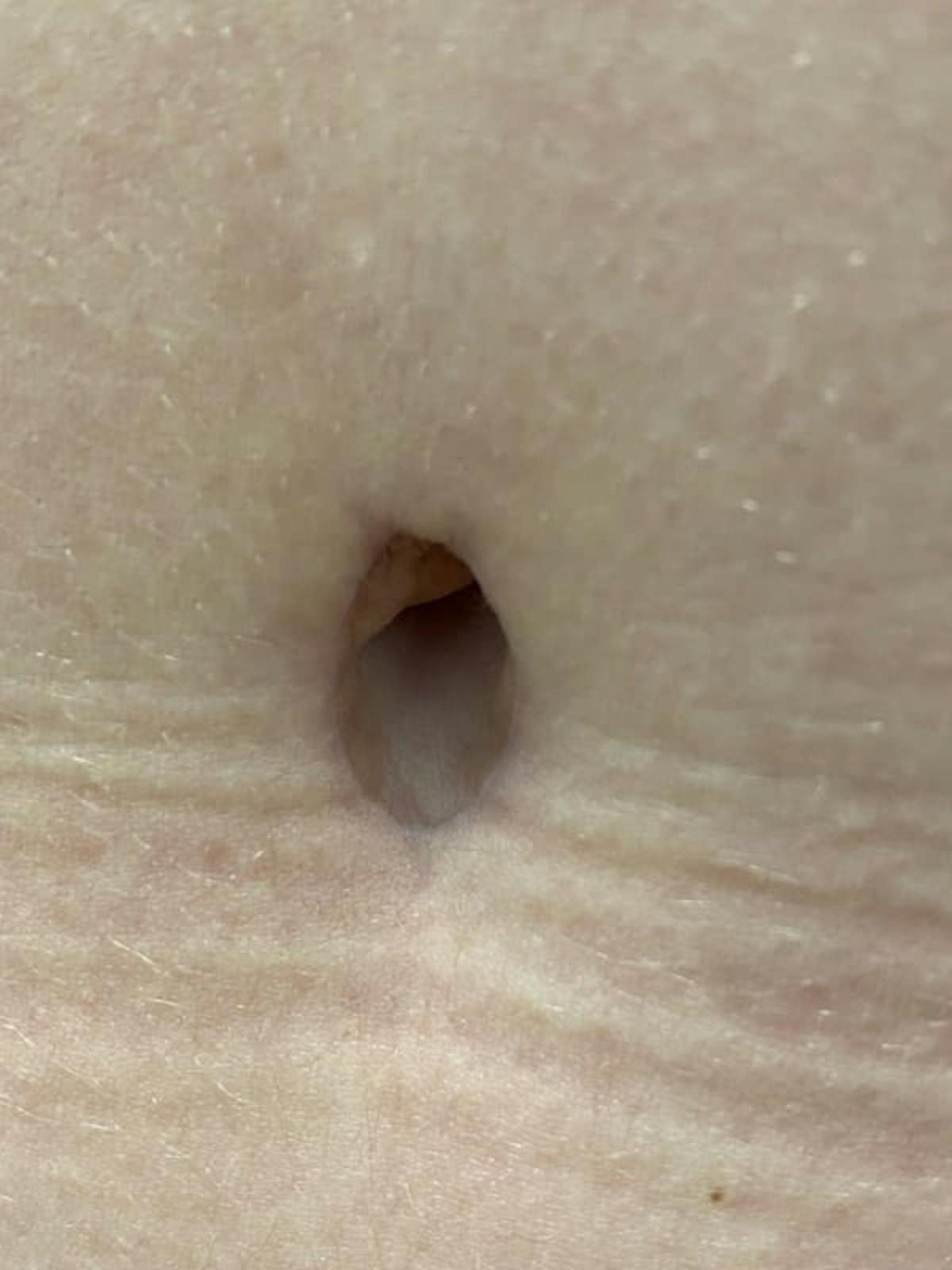 Belly Button Before & After Gallery - Patient 136810 - Image 1