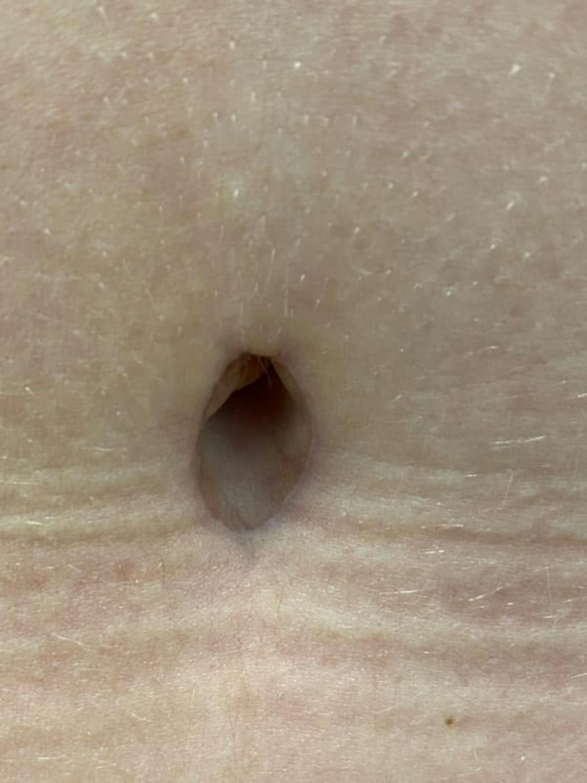 Belly Button Before & After Gallery - Patient 136810 - Image 2
