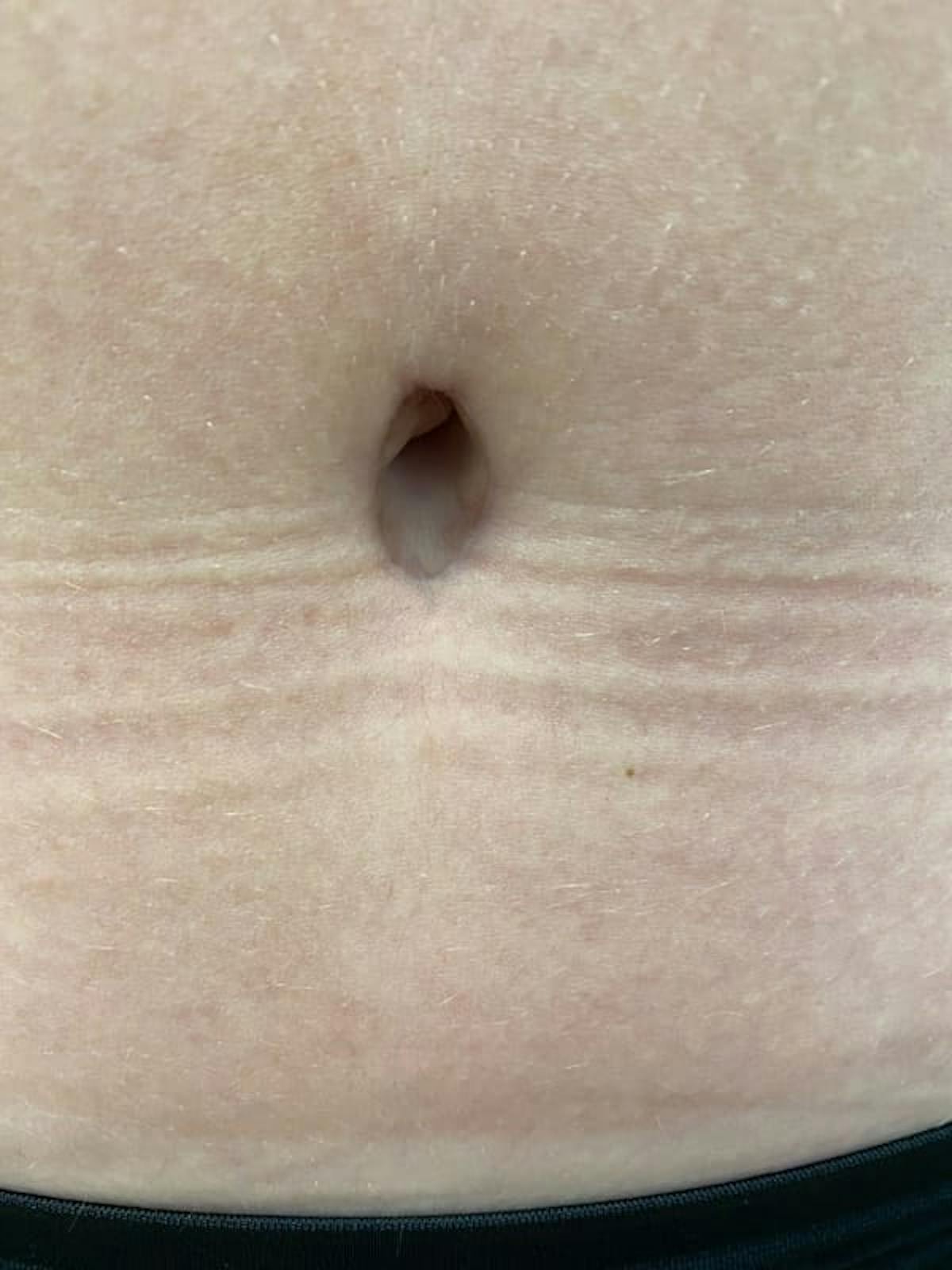 Belly Button Before & After Gallery - Patient 136810 - Image 3