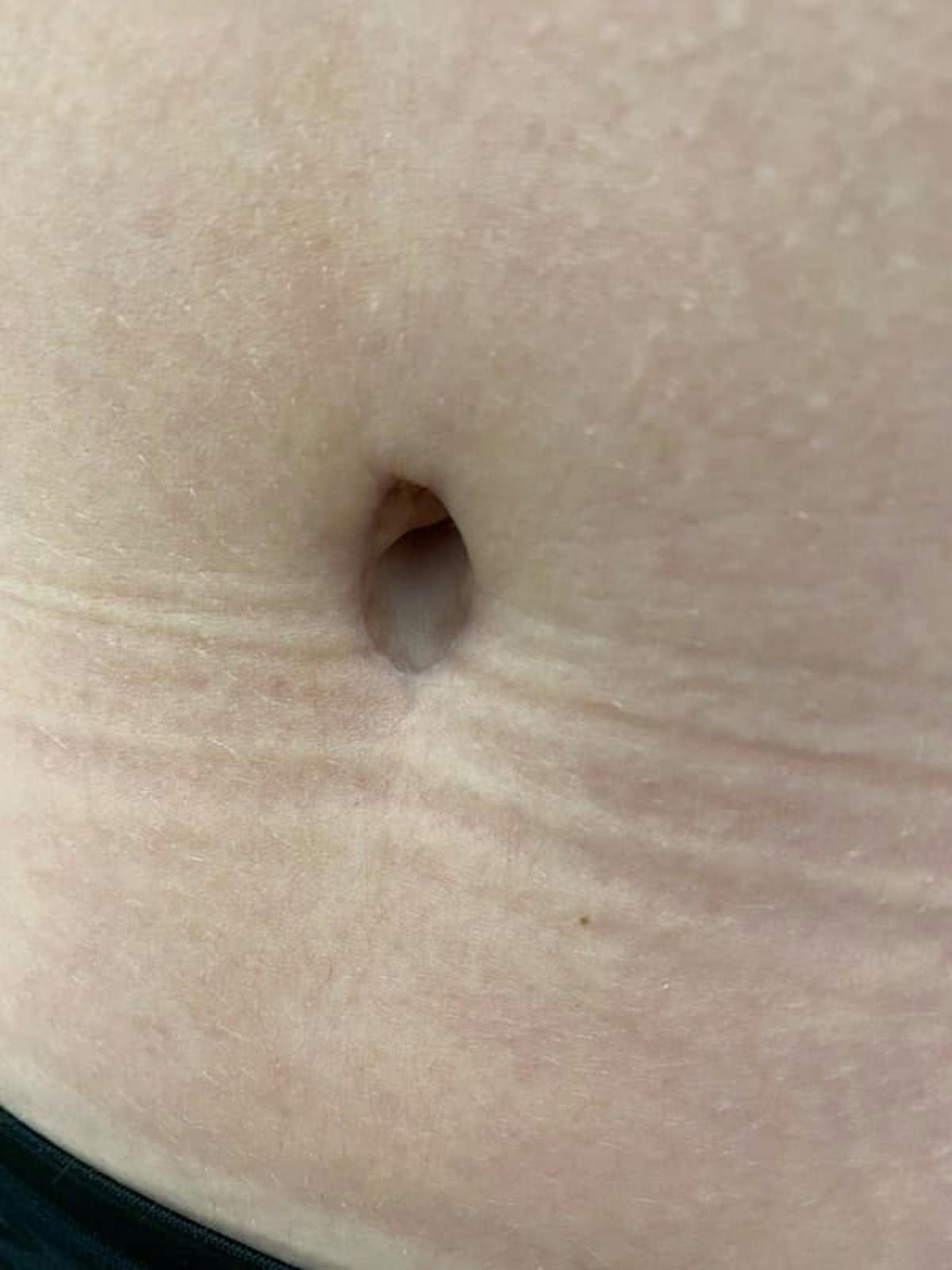 Belly Button Before & After Gallery - Patient 136810 - Image 4