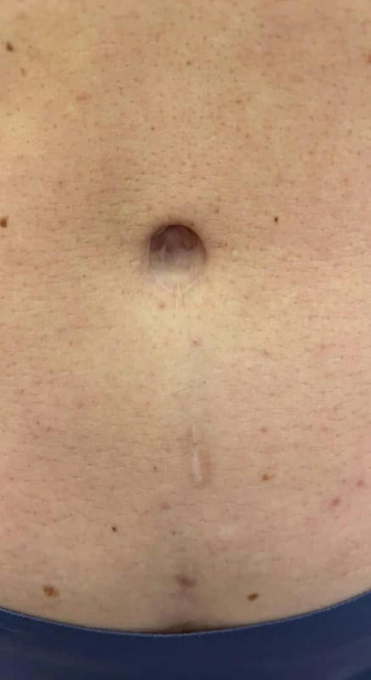 Belly Button Before & After Gallery - Patient 284446 - Image 1