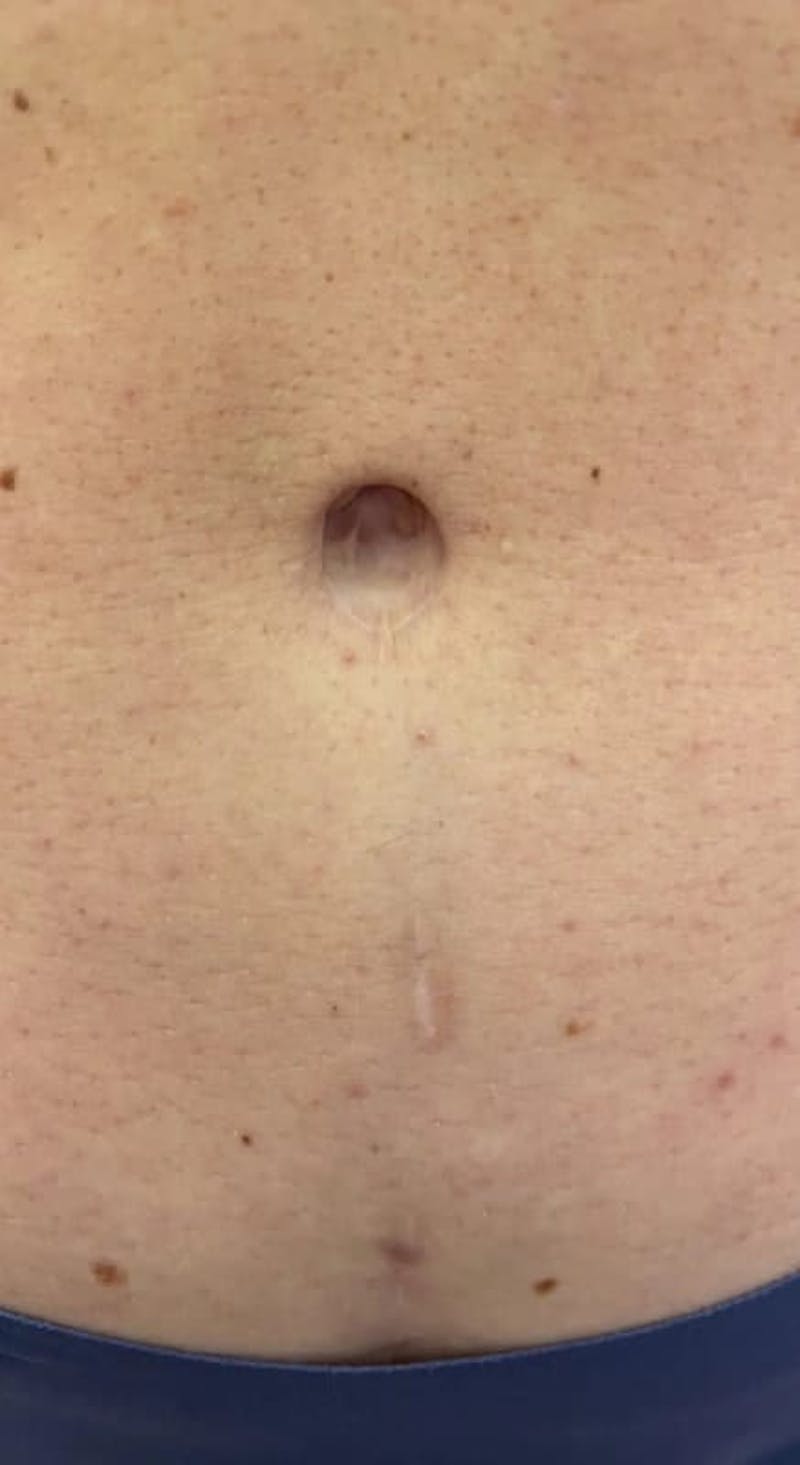Belly Button Before & After Gallery - Patient 284446 - Image 1