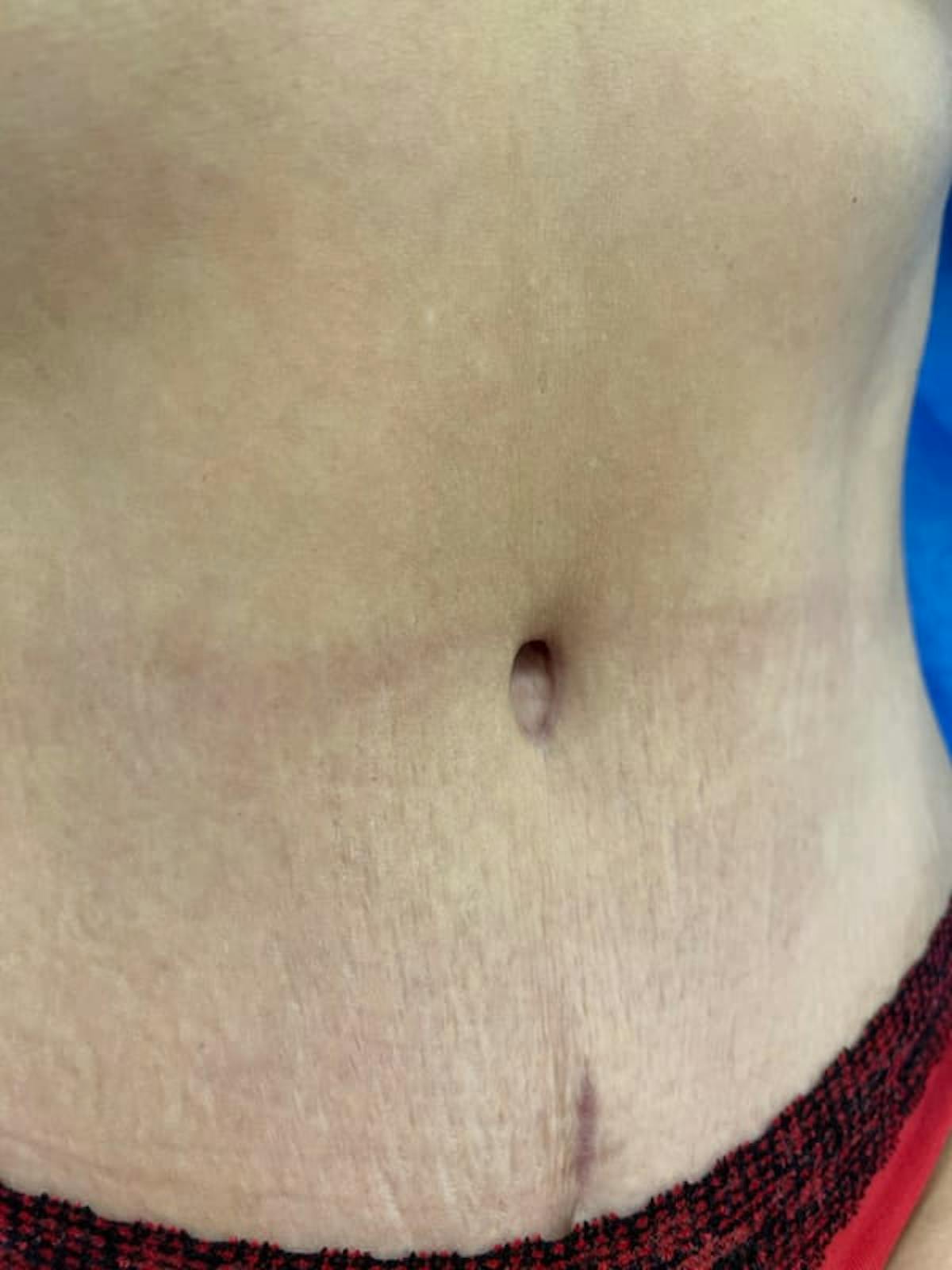 Belly Button Before & After Gallery - Patient 284446 - Image 2