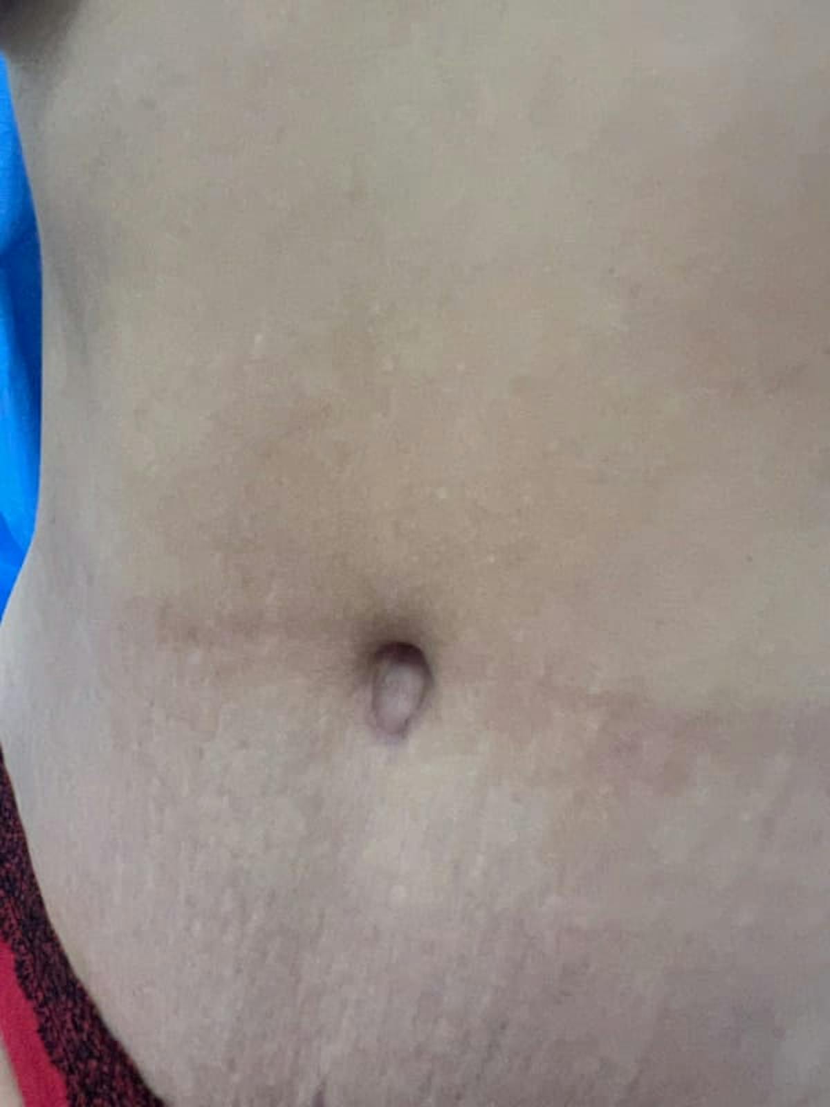 Belly Button Before & After Gallery - Patient 284446 - Image 3