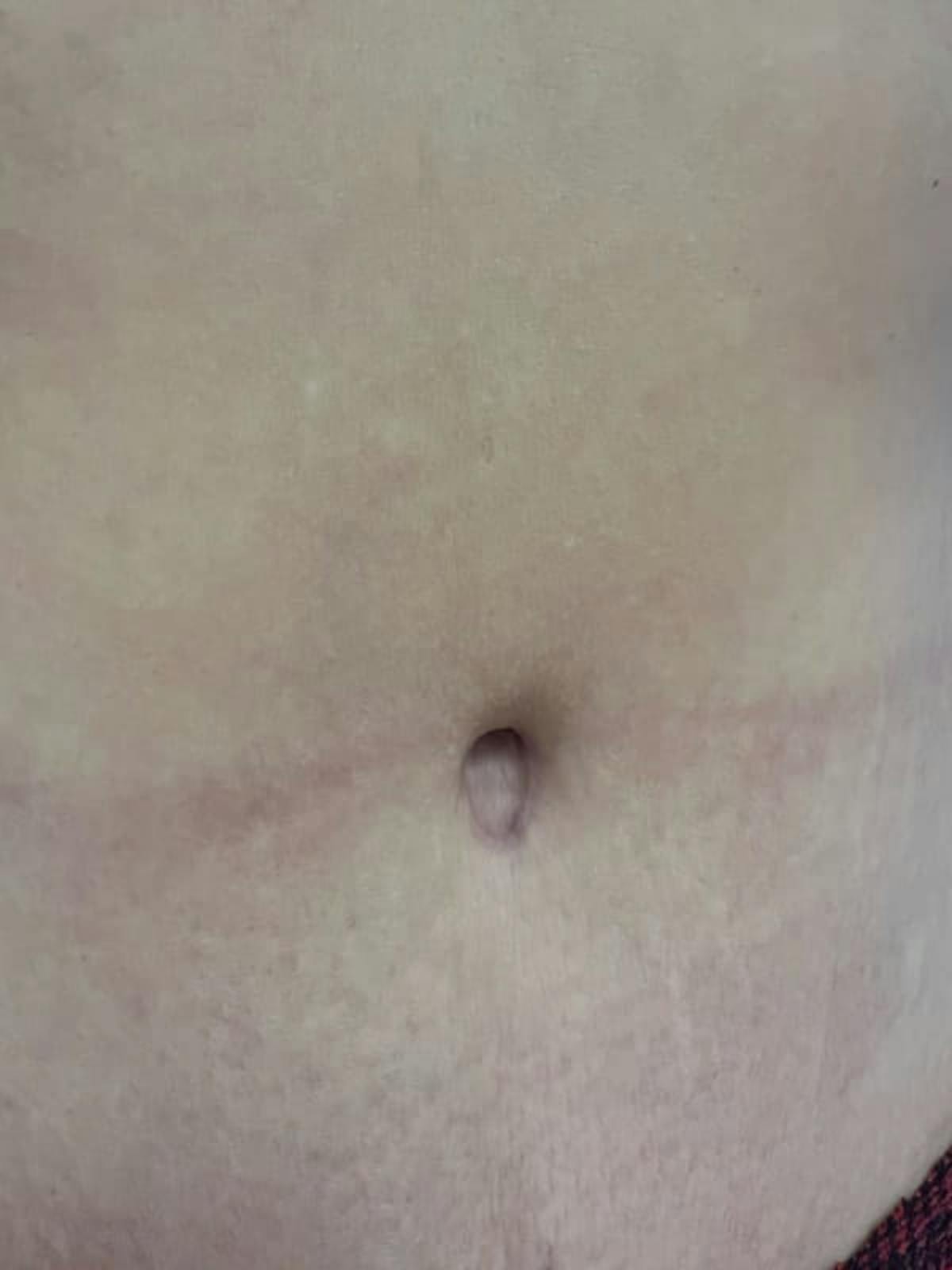 Belly Button Before & After Gallery - Patient 284446 - Image 4