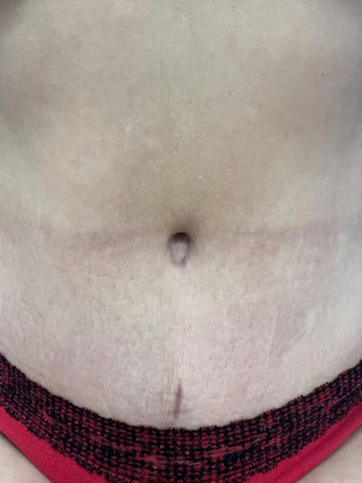 Belly Button Before & After Gallery - Patient 284446 - Image 5