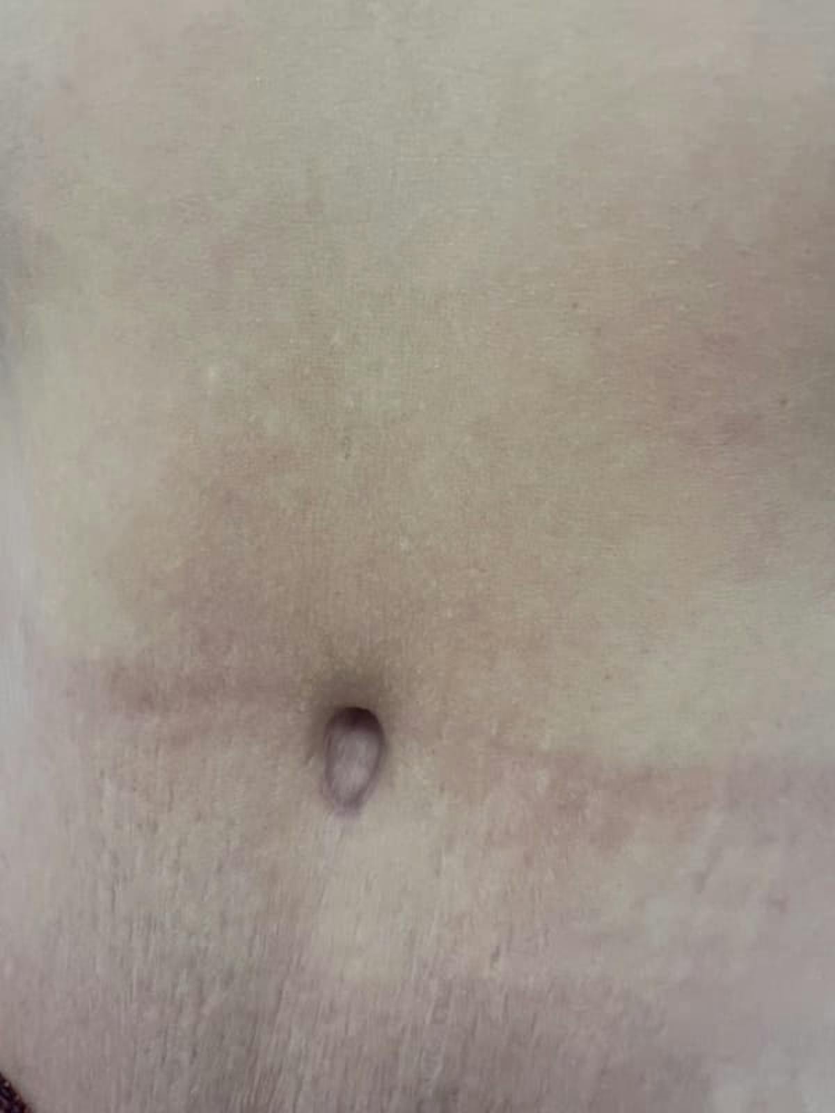 Belly Button Before & After Gallery - Patient 284446 - Image 7