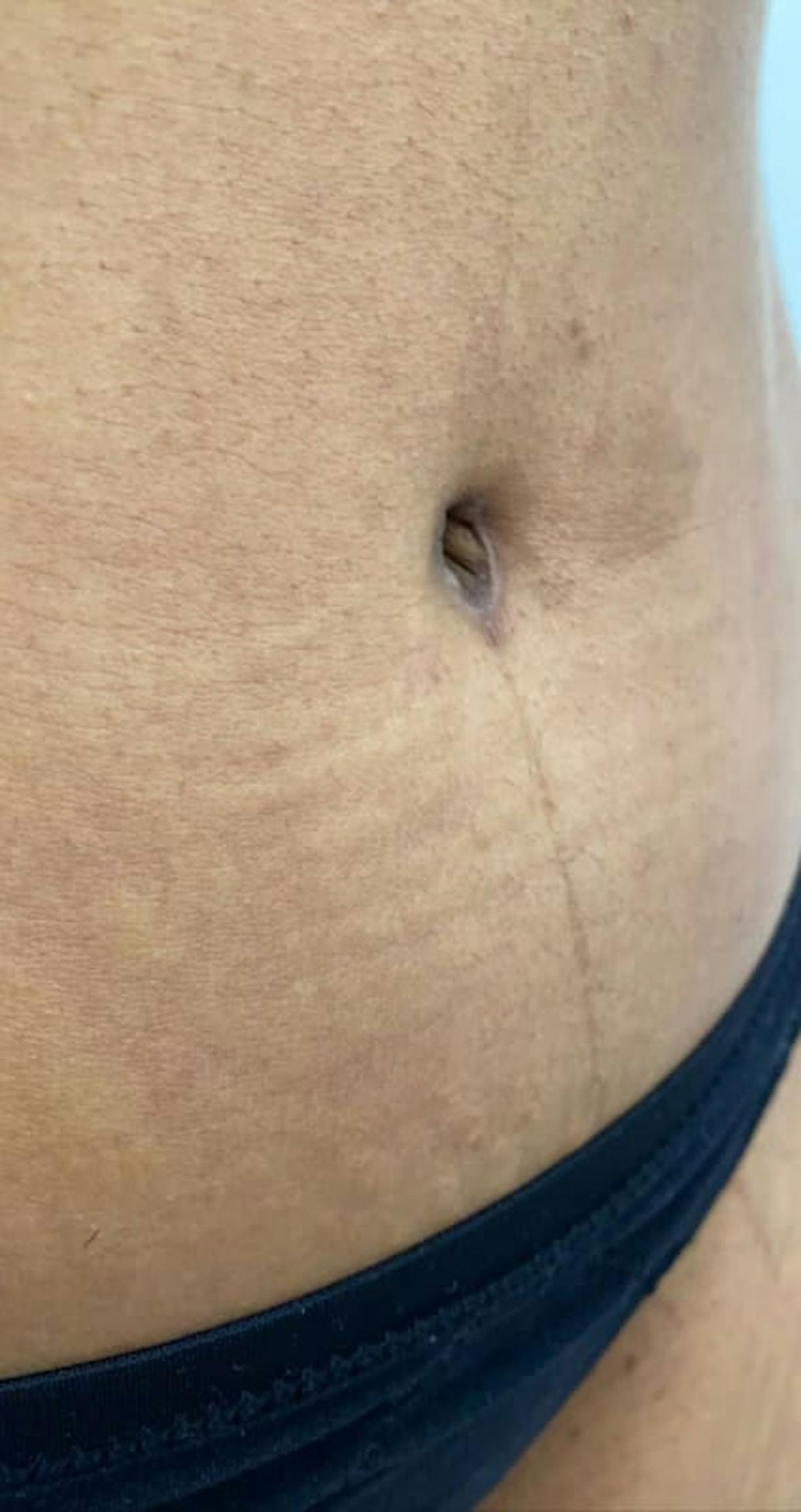 Belly Button Before & After Gallery - Patient 370785 - Image 1