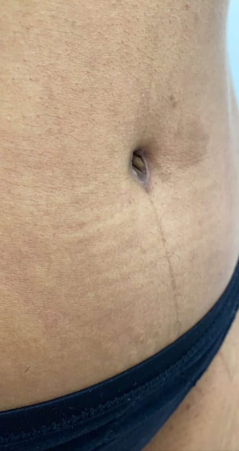 Belly Button Before & After Gallery - Patient 370785 - Image 1