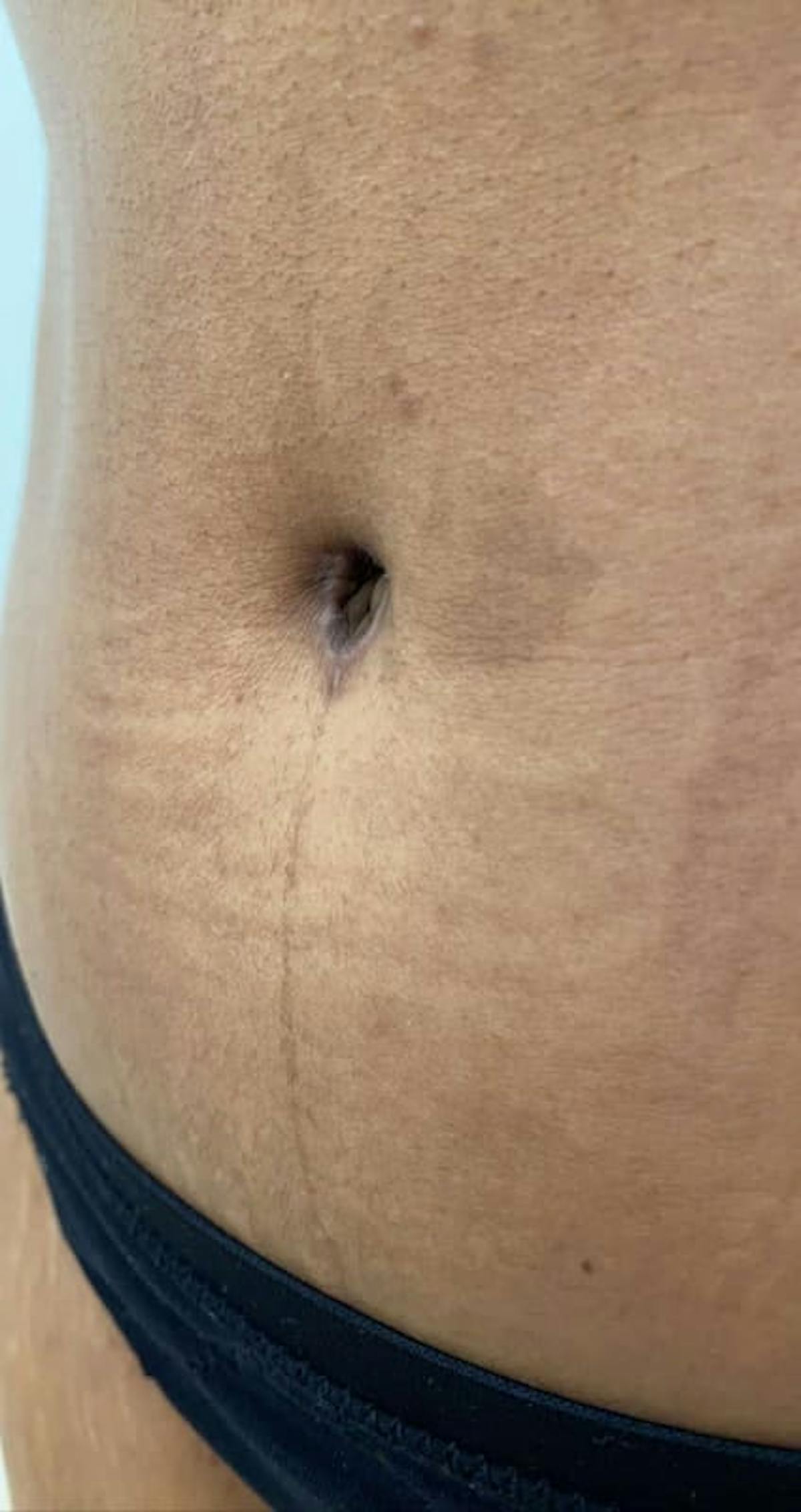 Belly Button Before & After Gallery - Patient 370785 - Image 2