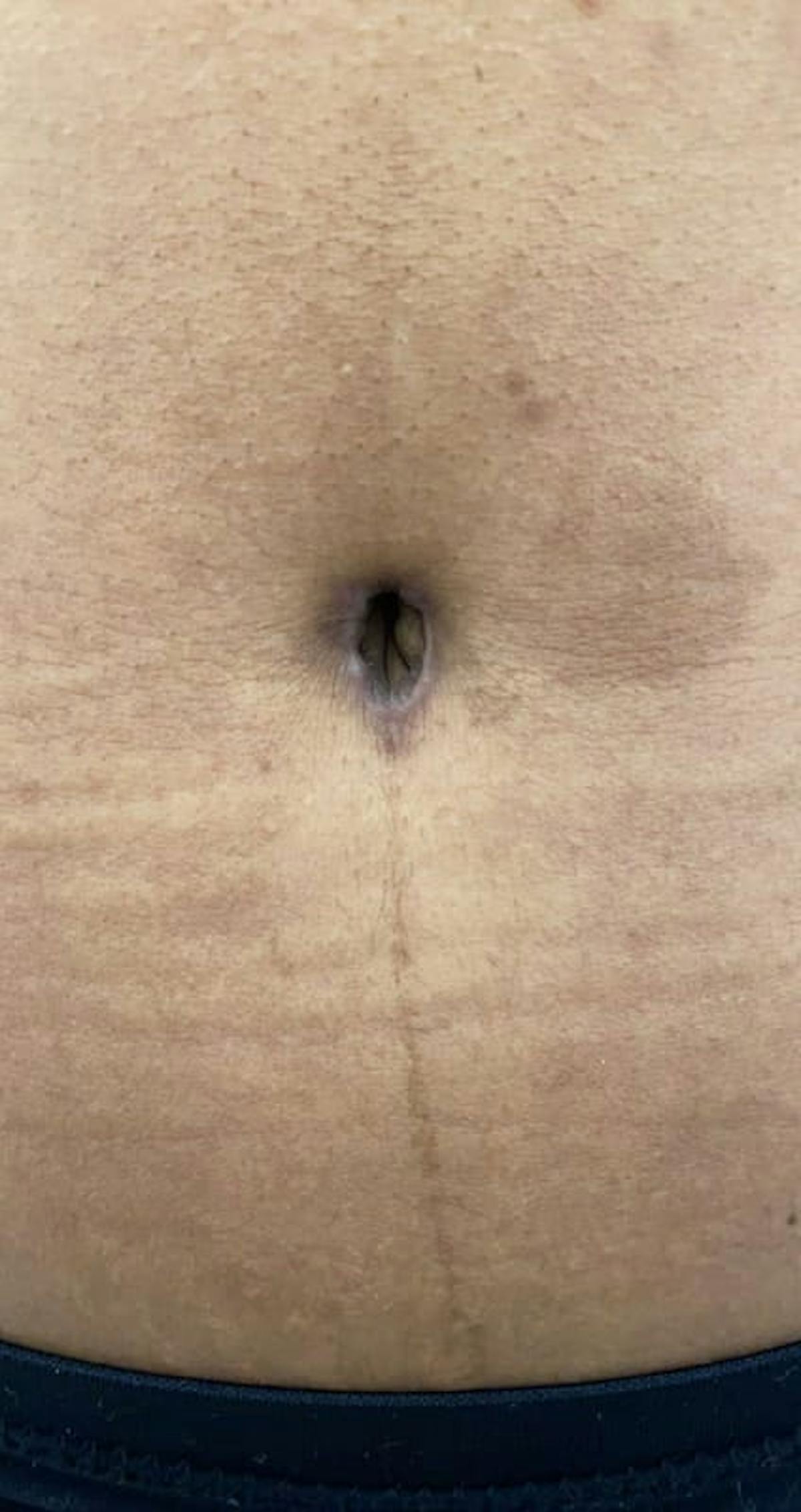 Belly Button Before & After Gallery - Patient 370785 - Image 3