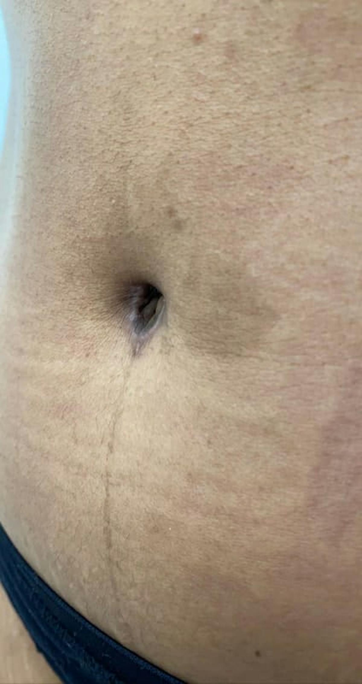 Belly Button Before & After Gallery - Patient 370785 - Image 4