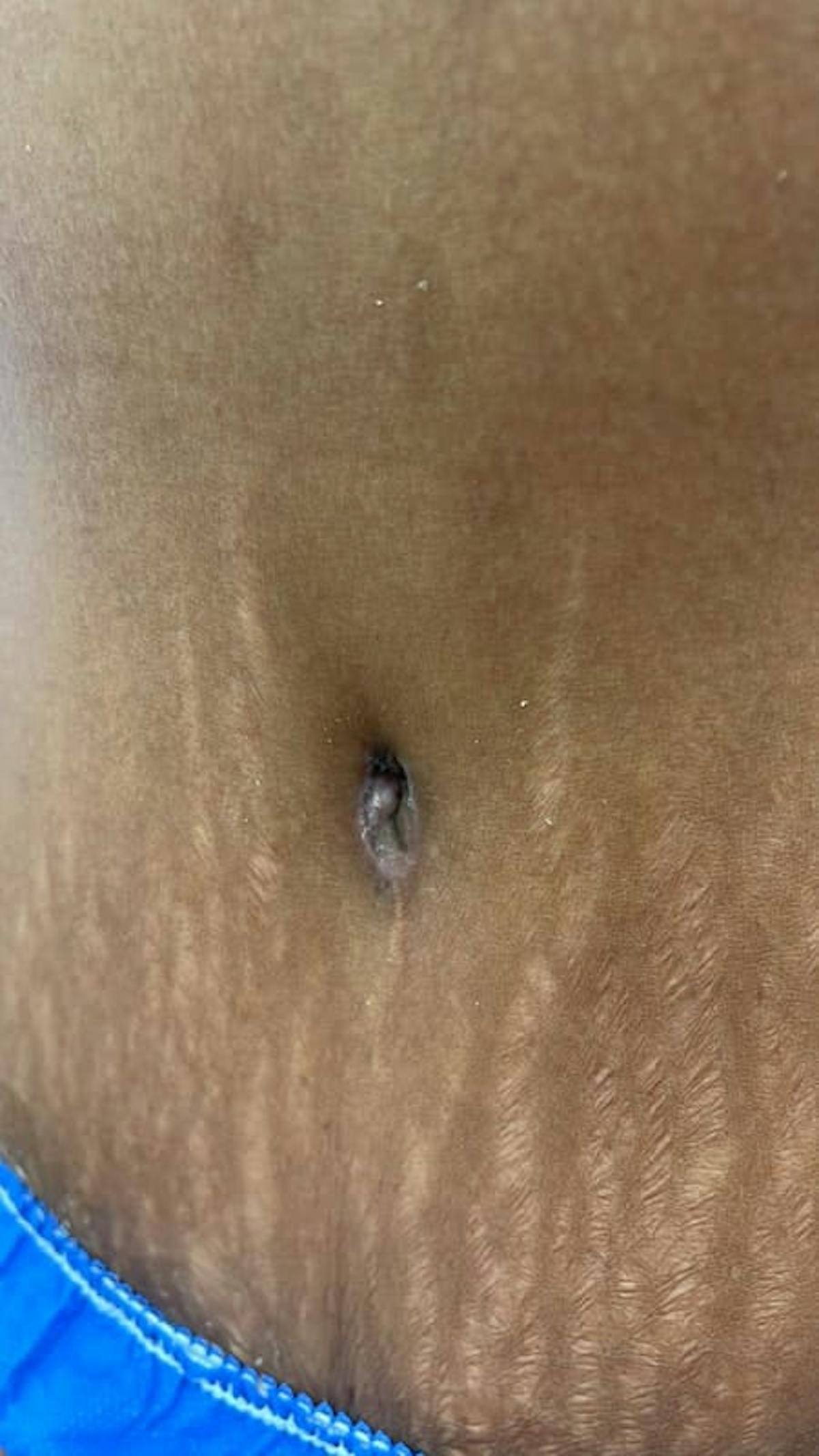 Belly Button Before & After Gallery - Patient 211531 - Image 1