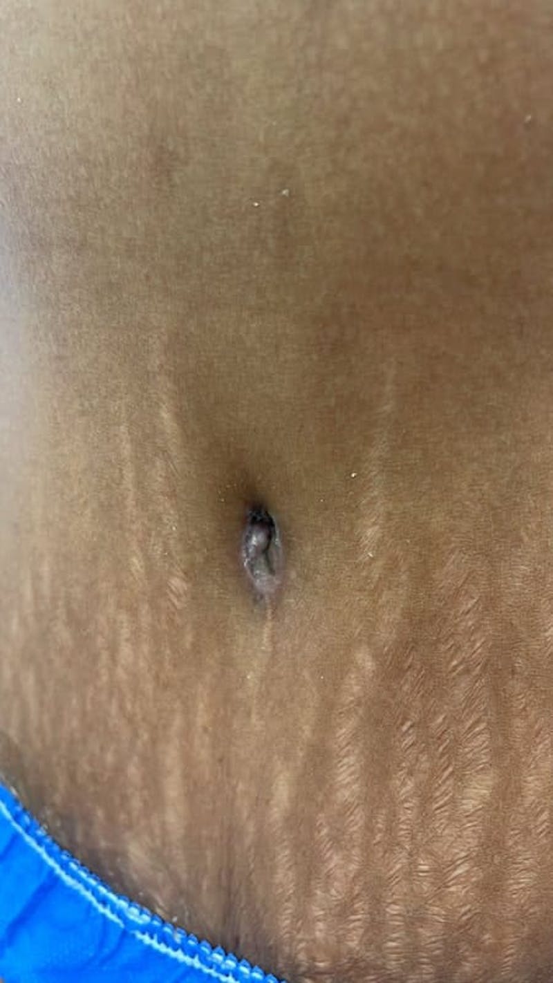 Belly Button Before & After Gallery - Patient 211531 - Image 1