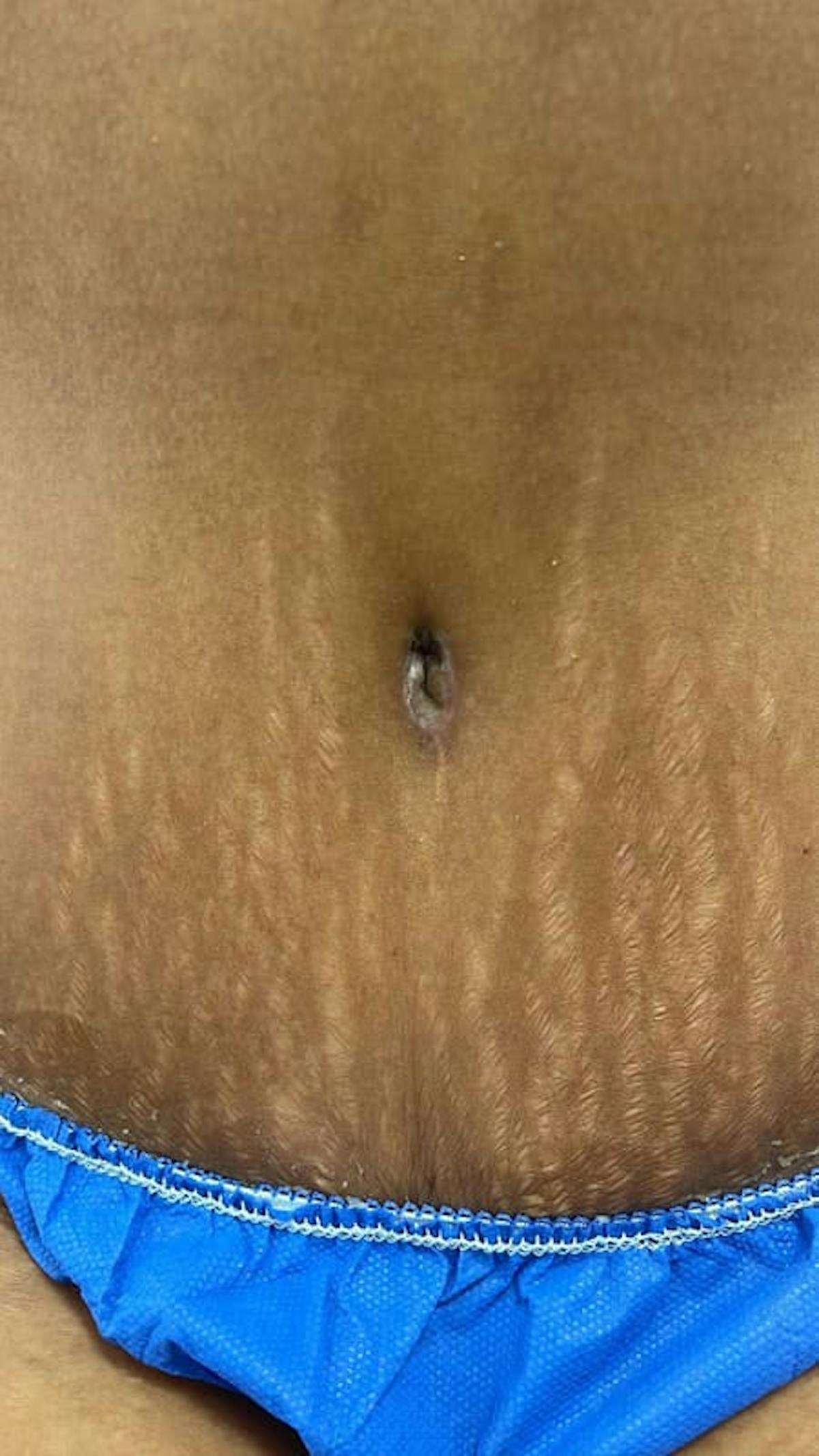 Belly Button Before & After Gallery - Patient 211531 - Image 2