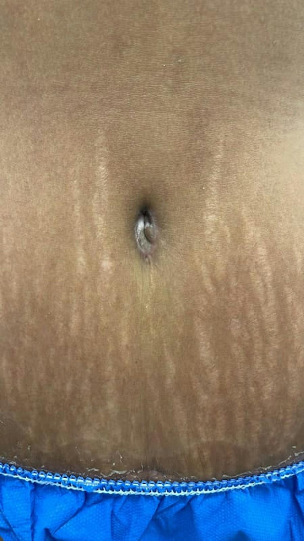 Belly Button Before & After Gallery - Patient 211531 - Image 3