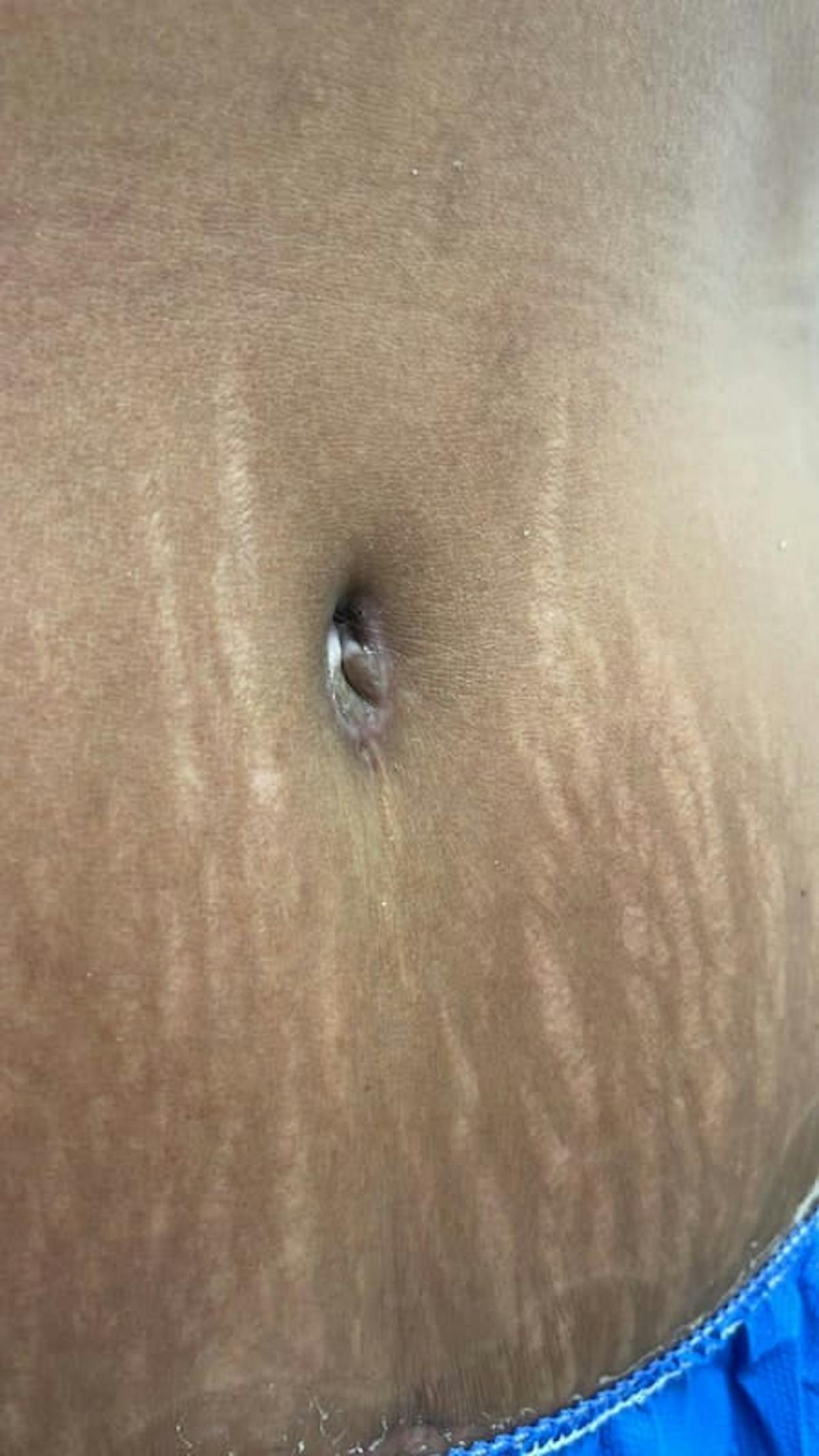 Belly Button Before & After Gallery - Patient 211531 - Image 4