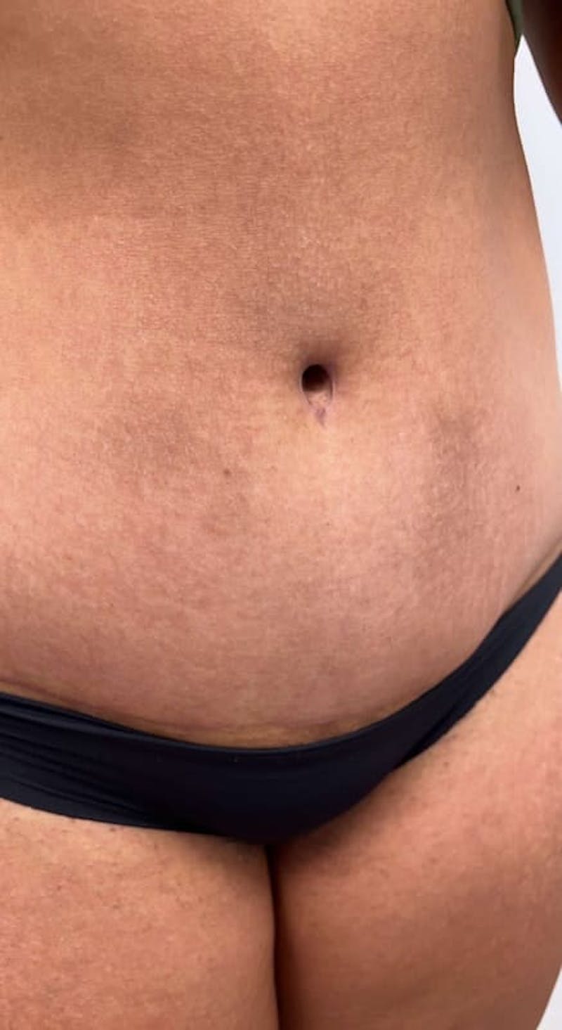 Belly Button Before & After Gallery - Patient 145053 - Image 1