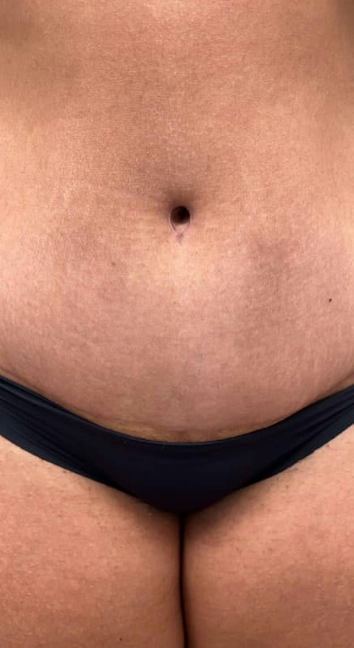 Belly Button Before & After Gallery - Patient 145053 - Image 2