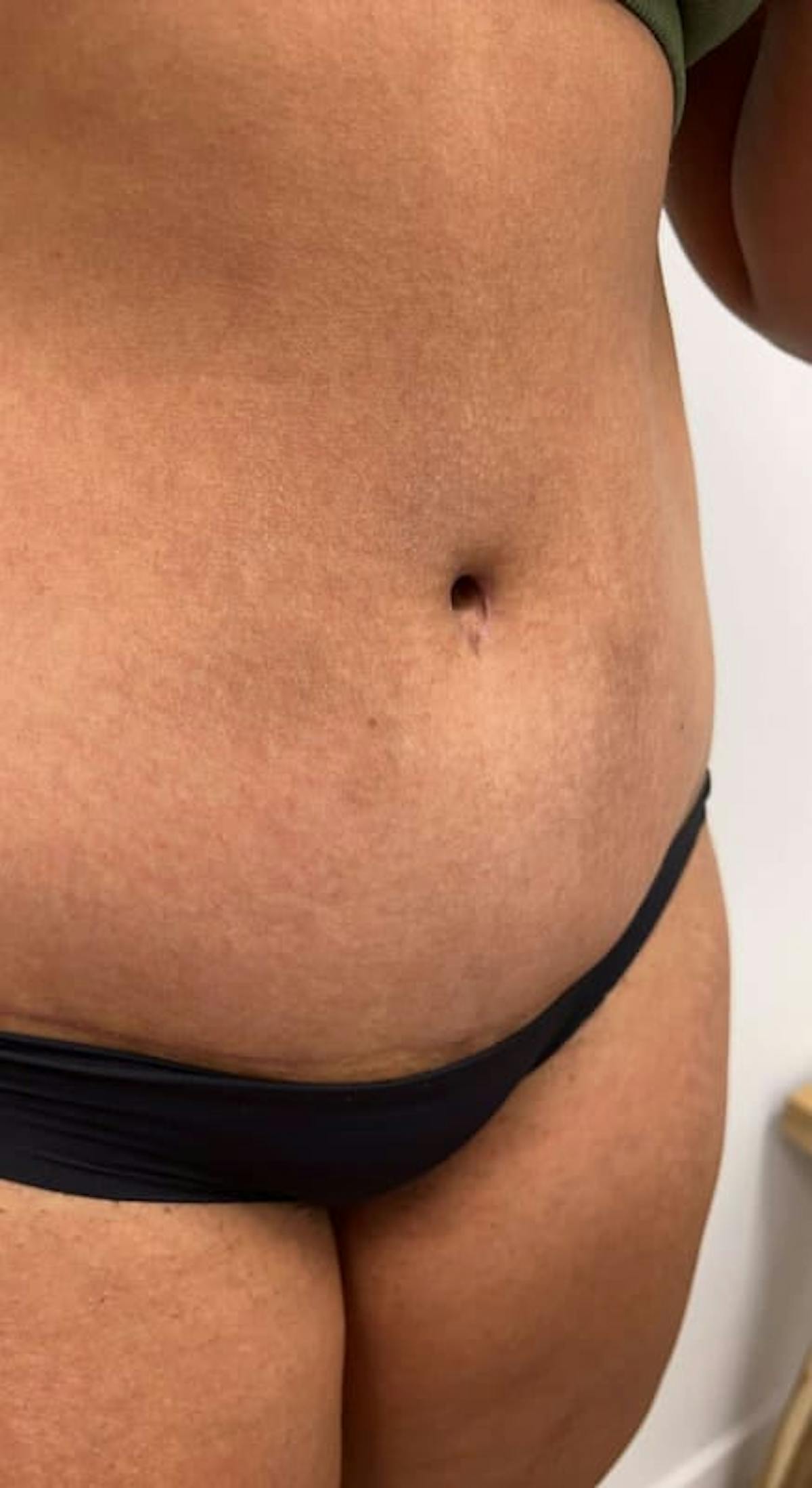 Belly Button Before & After Gallery - Patient 145053 - Image 3