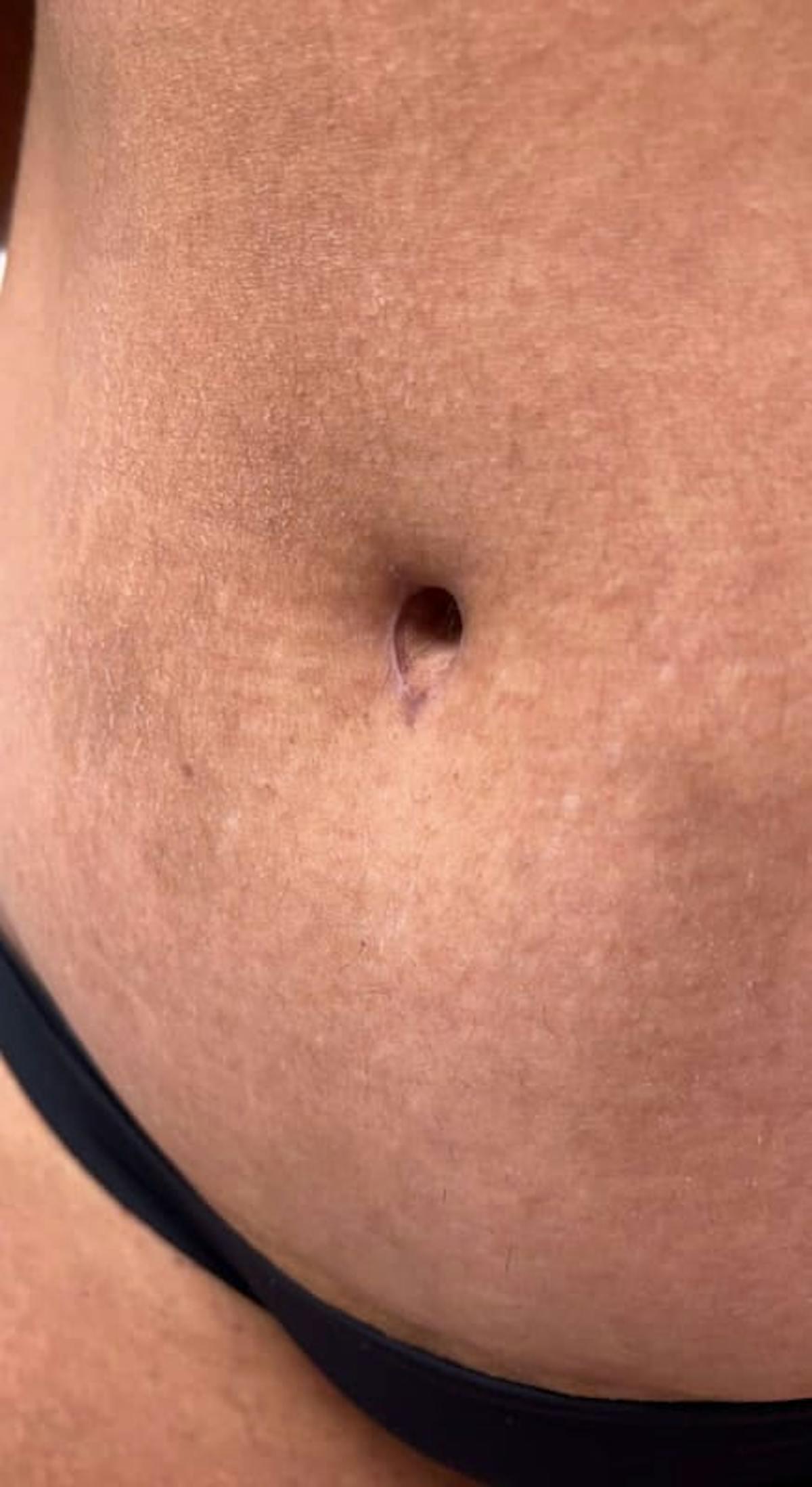 Belly Button Before & After Gallery - Patient 145053 - Image 4