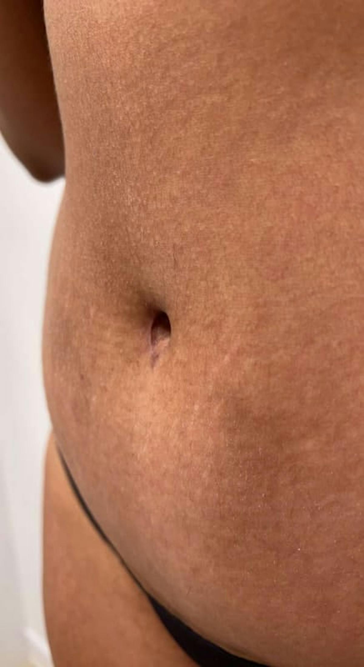 Belly Button Before & After Gallery - Patient 145053 - Image 5
