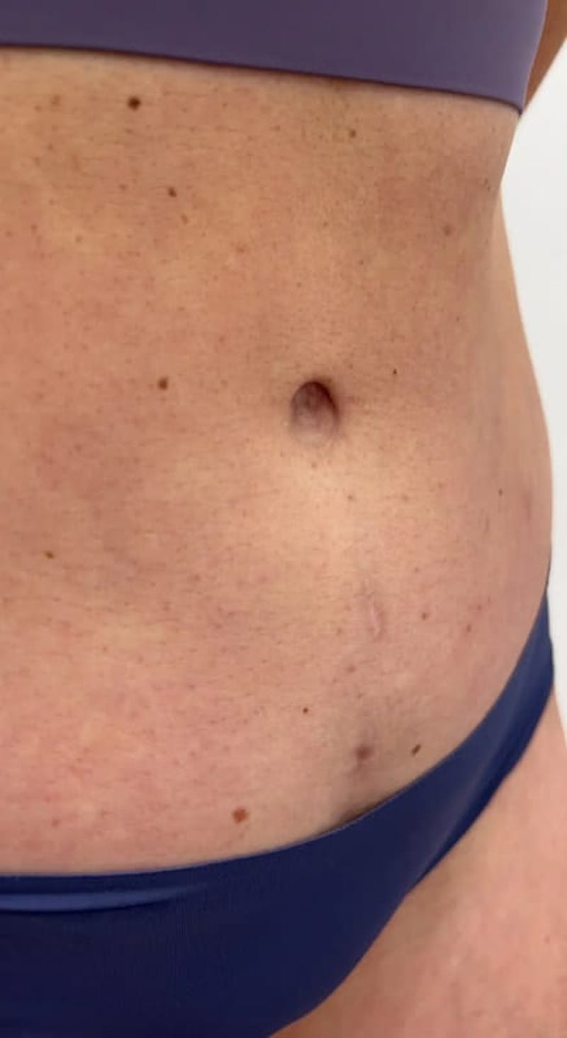 Belly Button Before & After Gallery - Patient 223047 - Image 1