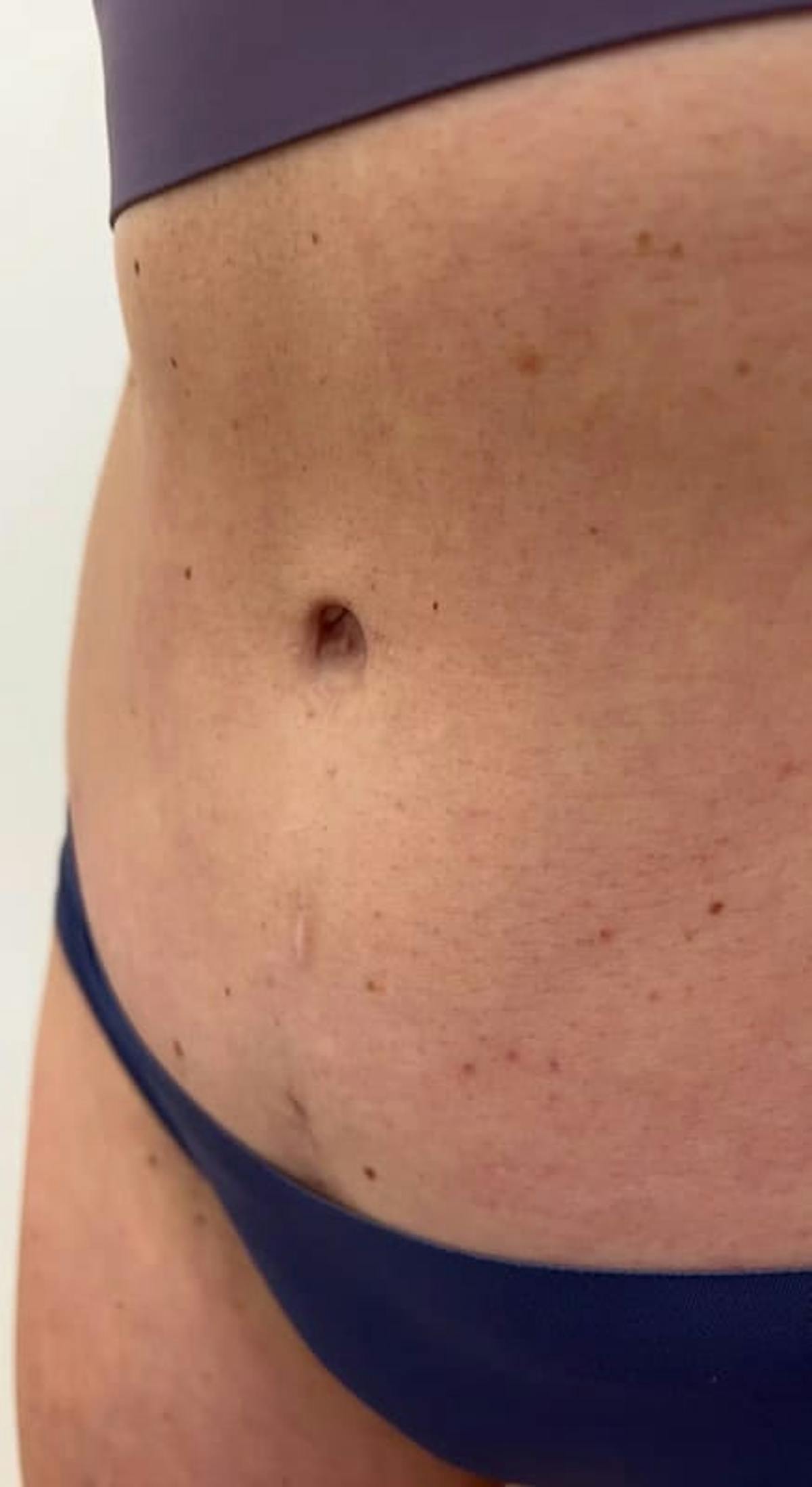 Belly Button Before & After Gallery - Patient 223047 - Image 2