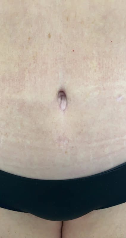 Patient 103529 | Belly Button Before & After Photos | Oppenheimer