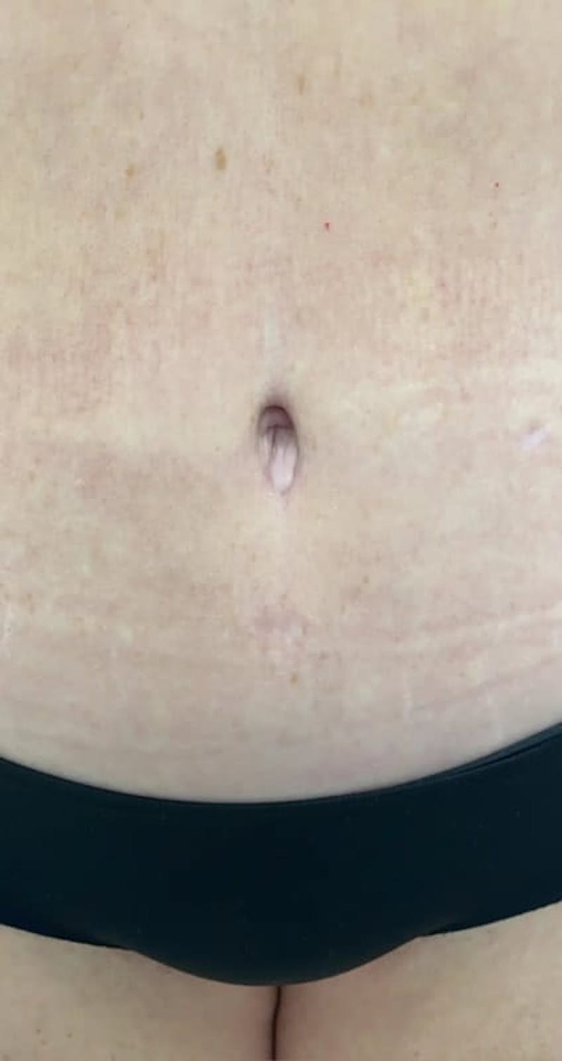 Belly Button Before & After Gallery - Patient 103529 - Image 1